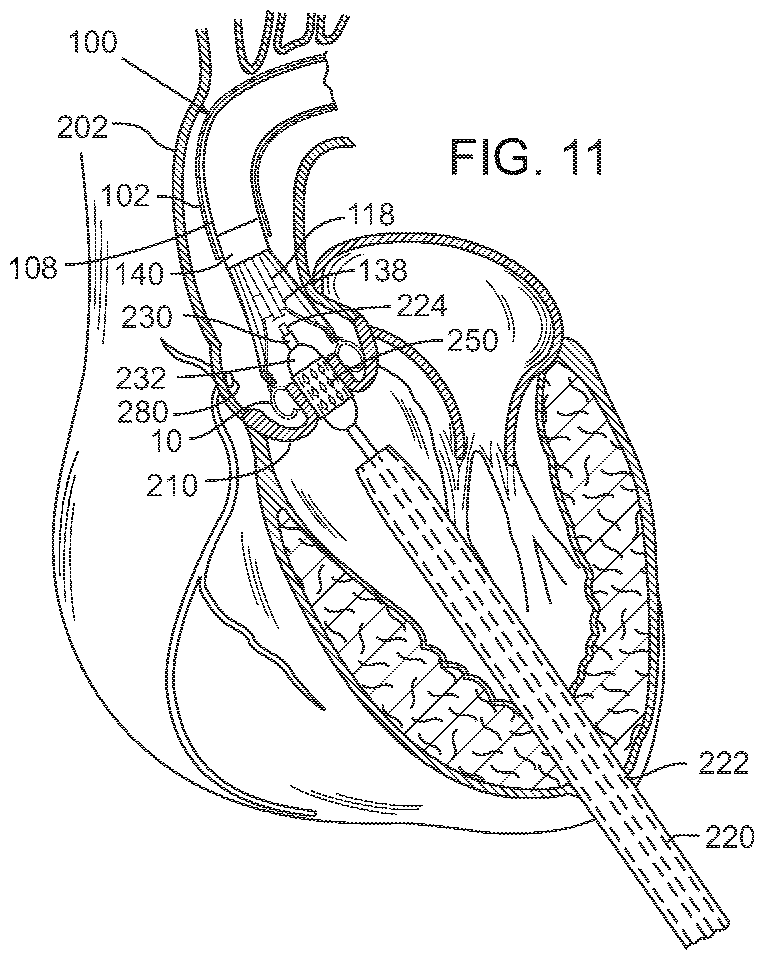 Patent US12090049 Figure 7 – Retaining mechanisms for prosthetic valves