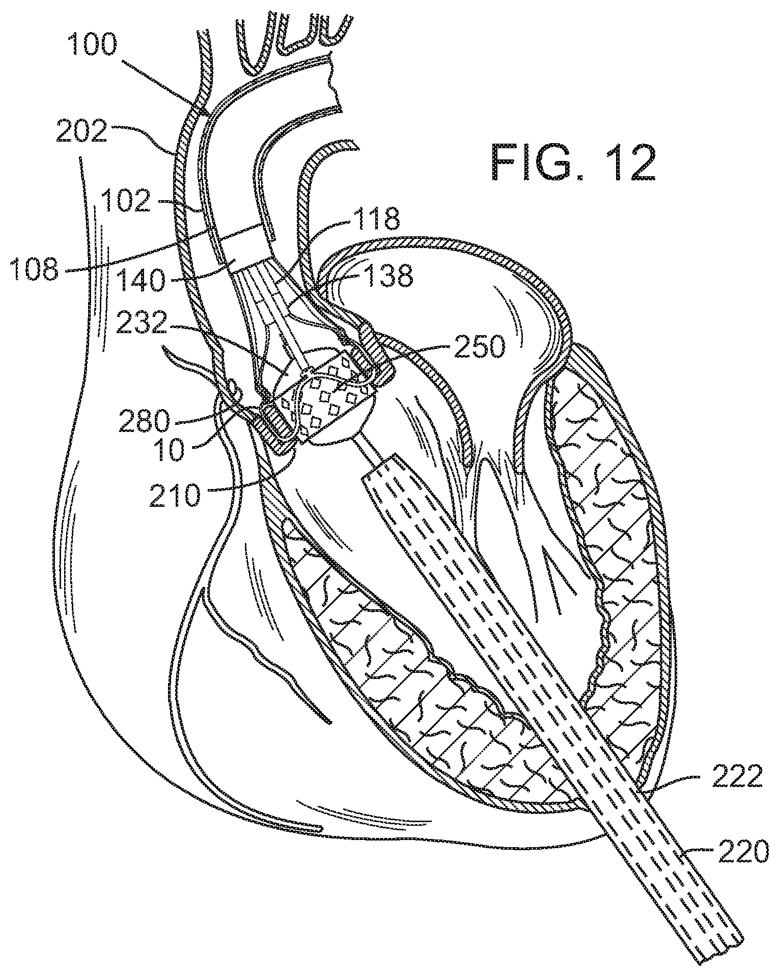 Patent US12090049 Figure 8 – Retaining mechanisms for prosthetic valves