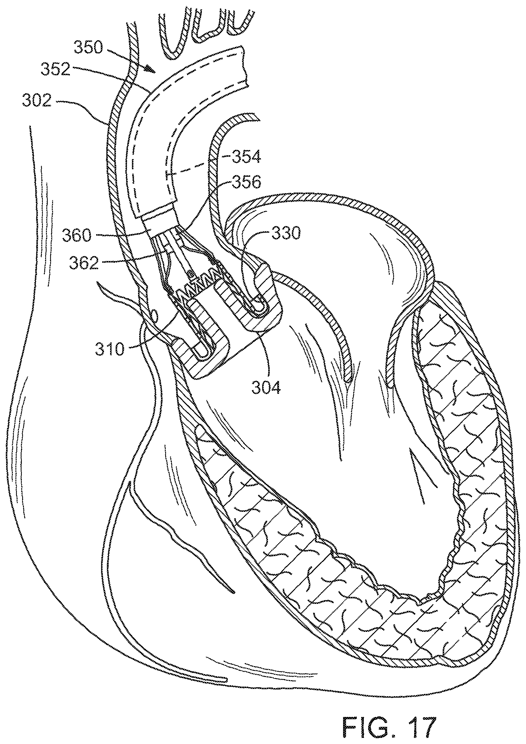 Patent US12090049 Figure 11 – Retaining mechanisms for prosthetic valves