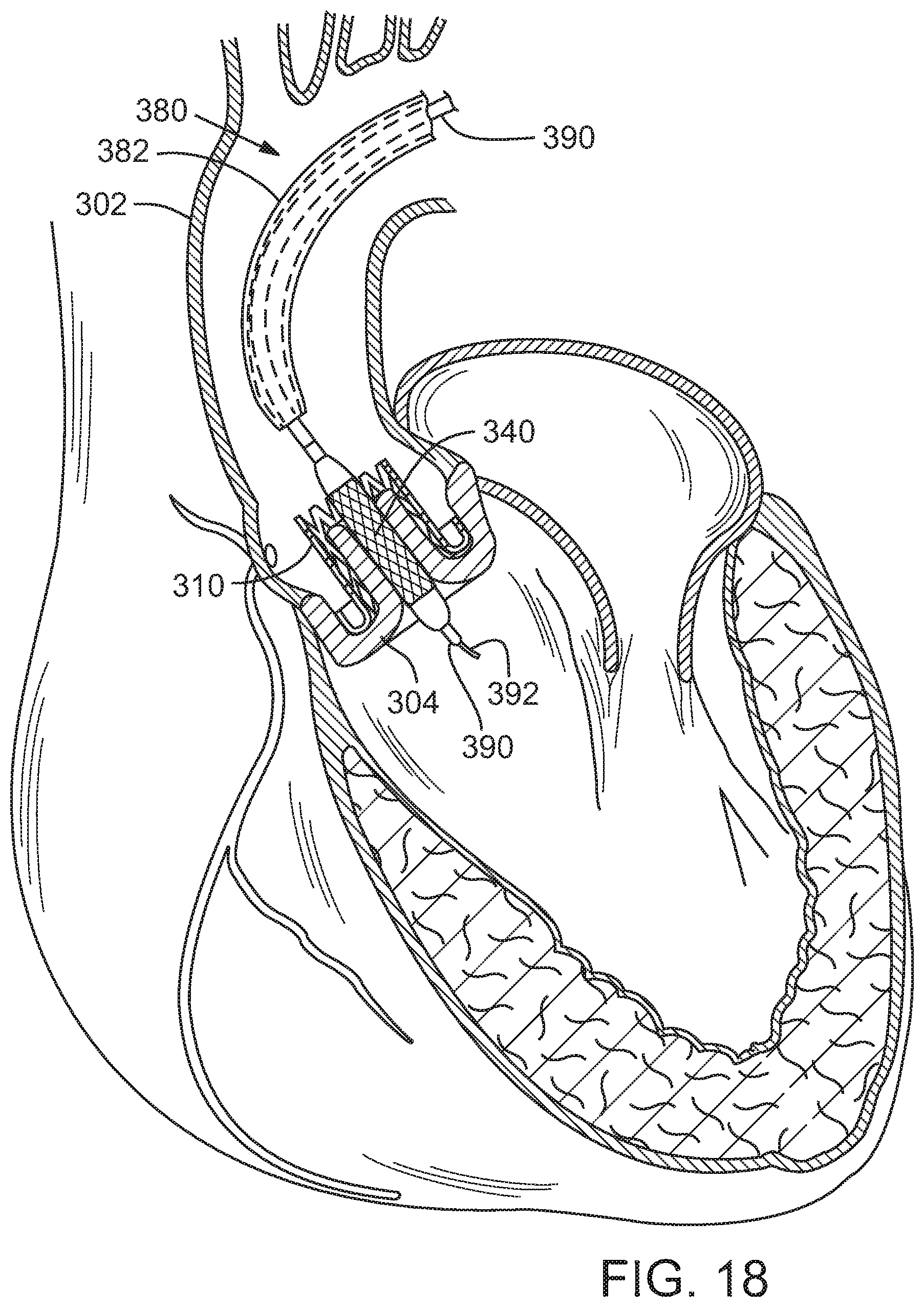 Patent US12090049 Figure 12 – Retaining mechanisms for prosthetic valves