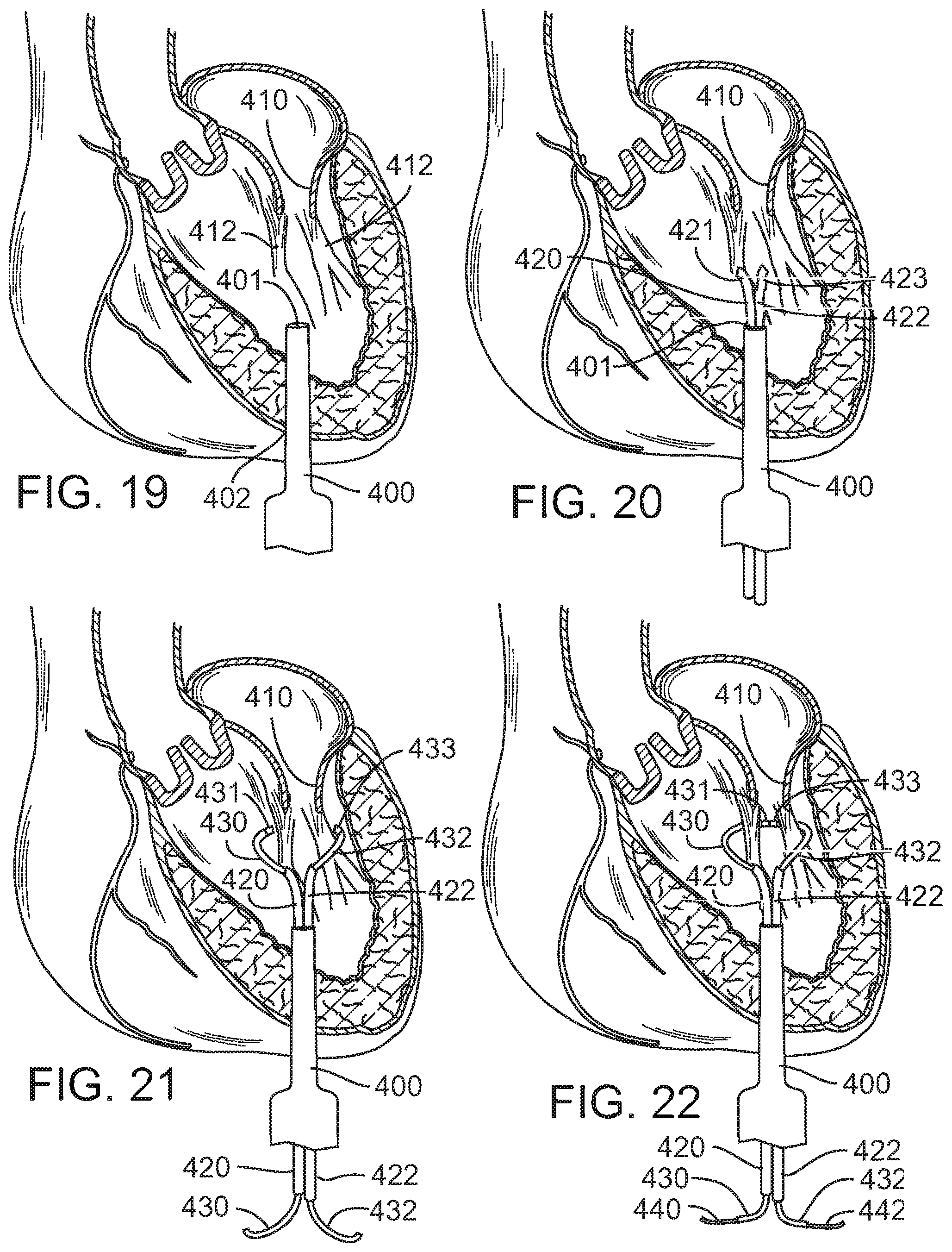 Patent US12090049 Figure 13 – Retaining mechanisms for prosthetic valves