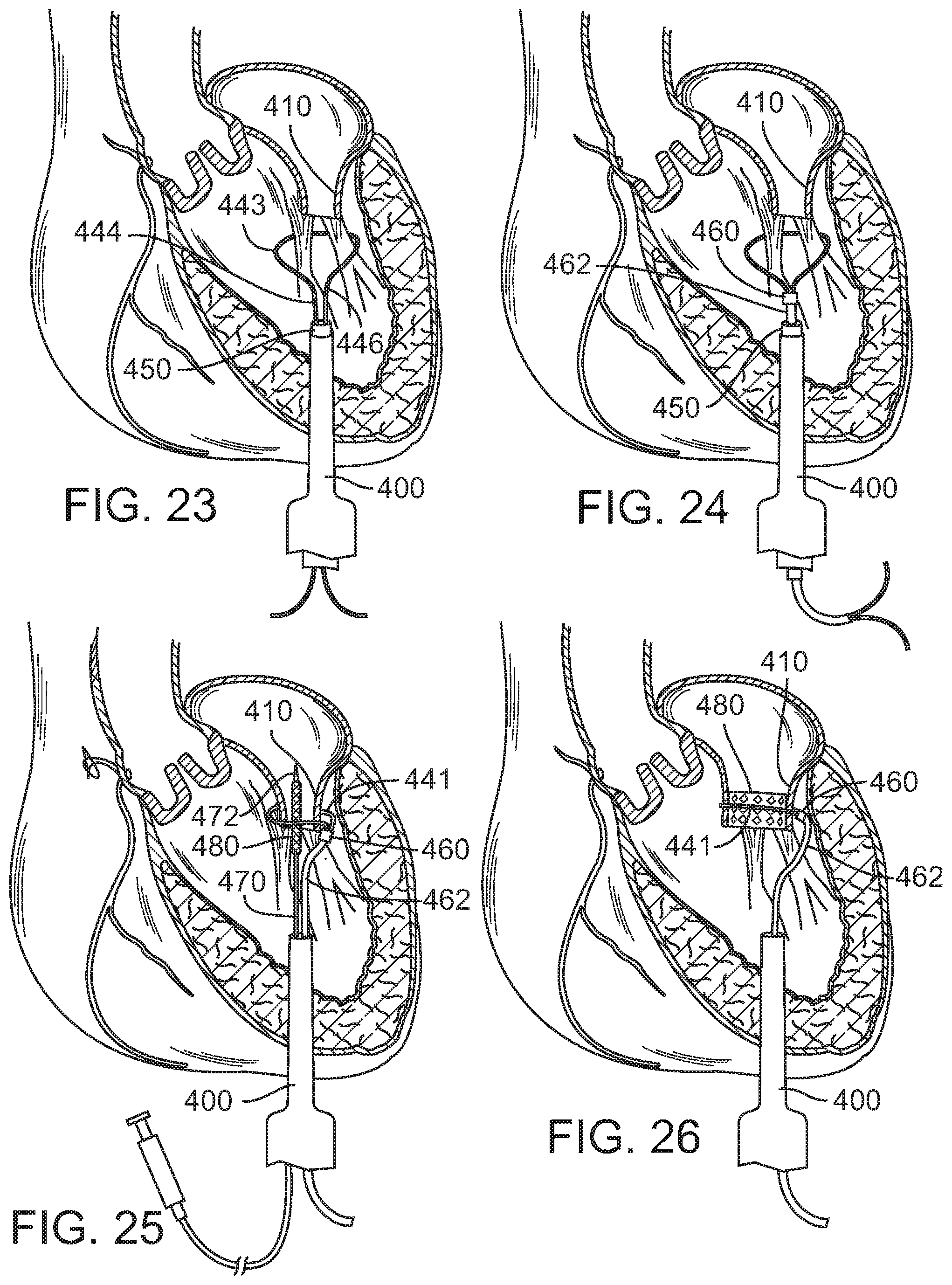 Patent US12090049 Figure 14 – Retaining mechanisms for prosthetic valves
