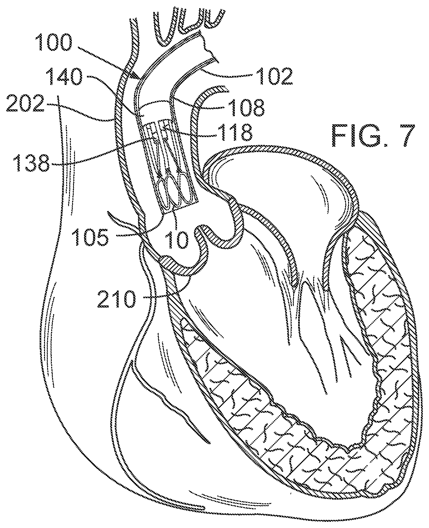 Patent US12090050 Figure 3 – Method for delivering a support member to a native heart valve