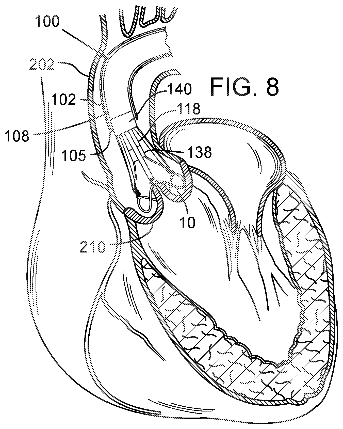 Patent US12090050 Figure 4 – Method for delivering a support member to a native heart valve