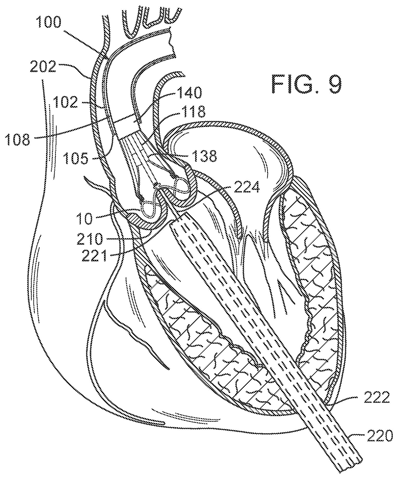 Patent US12090050 Figure 5 – Method for delivering a support member to a native heart valve