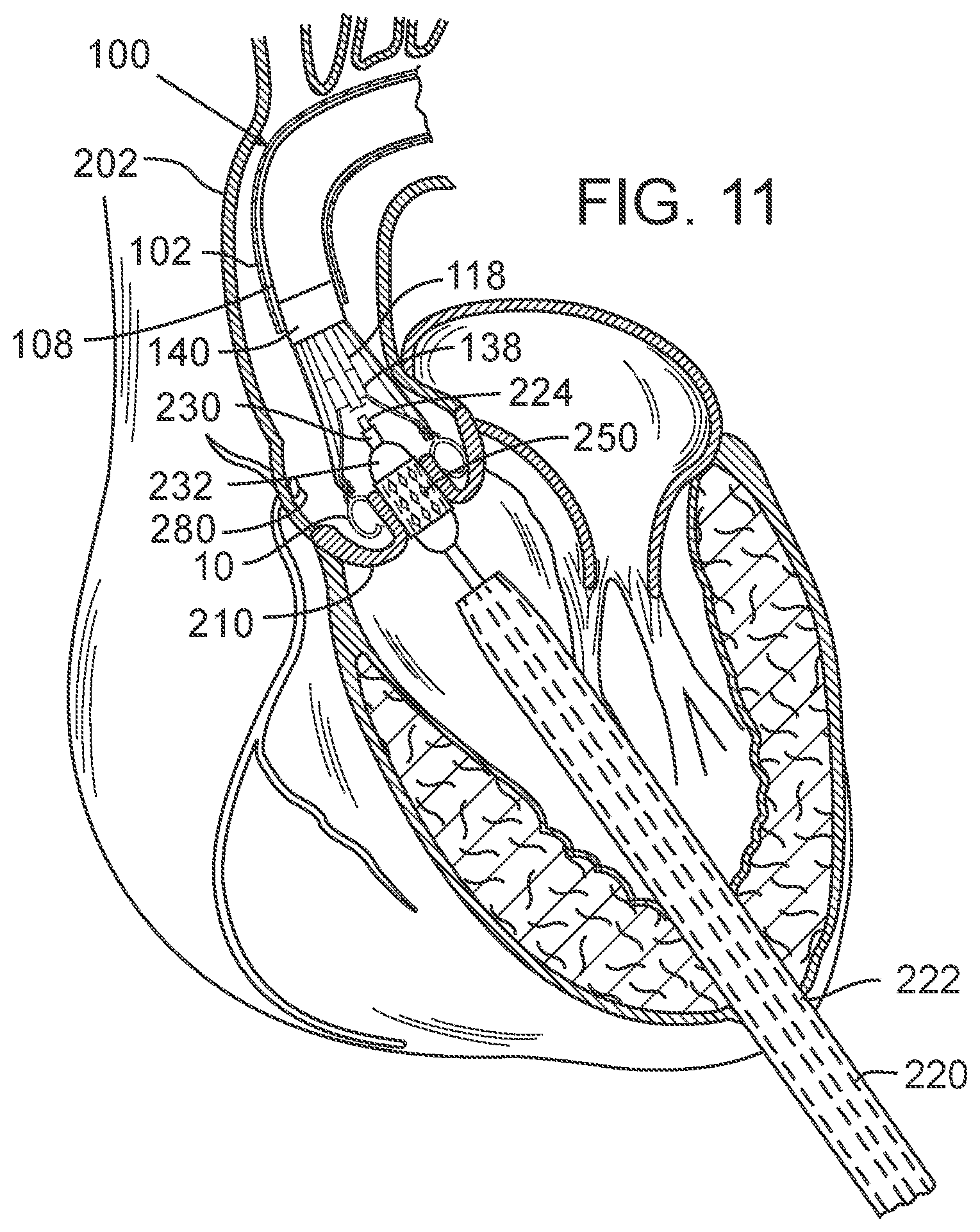 Patent US12090050 Figure 7 – Method for delivering a support member to a native heart valve
