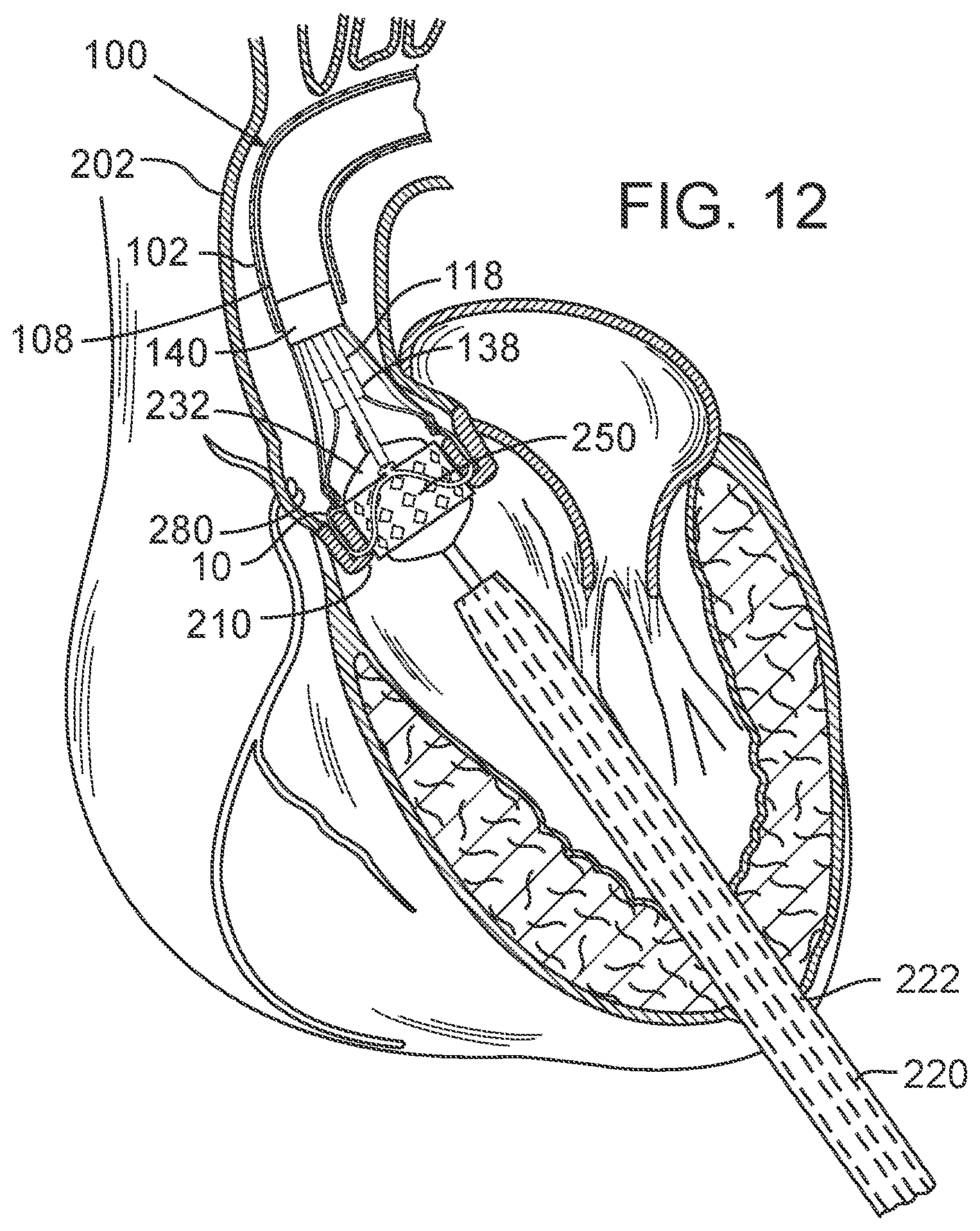 Patent US12090050 Figure 8 – Method for delivering a support member to a native heart valve