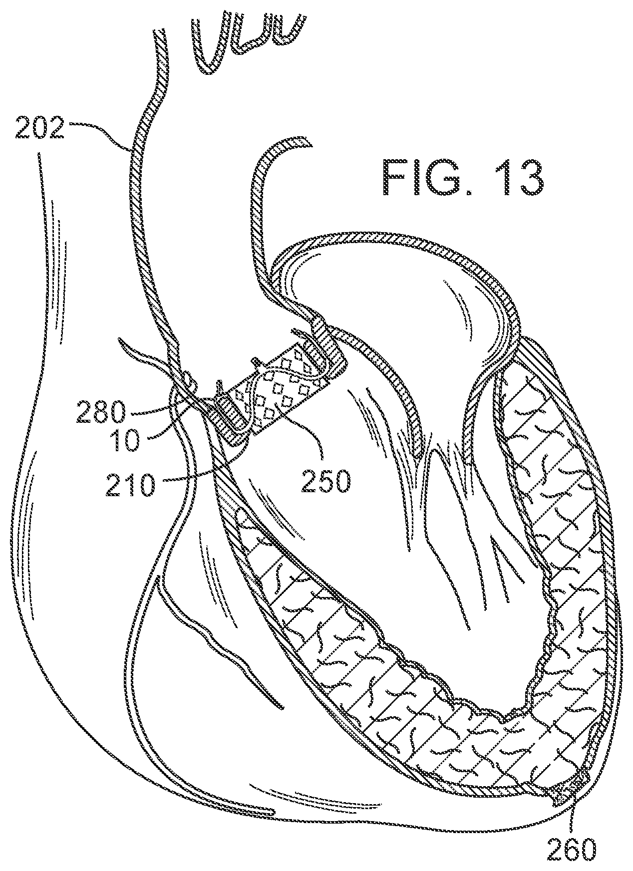 Patent US12090050 Figure 9 – Method for delivering a support member to a native heart valve