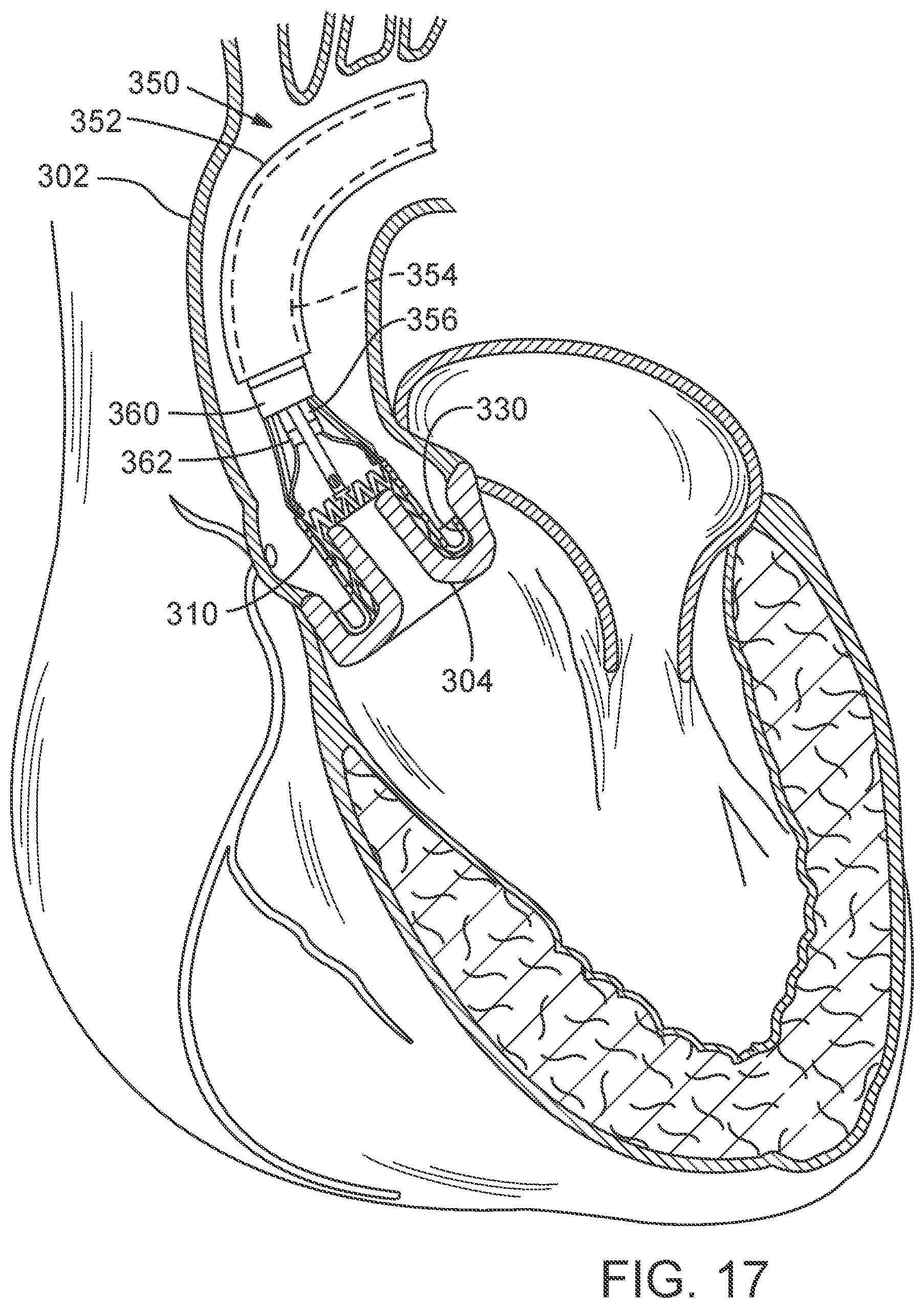 Patent US12090050 Figure 11 – Method for delivering a support member to a native heart valve