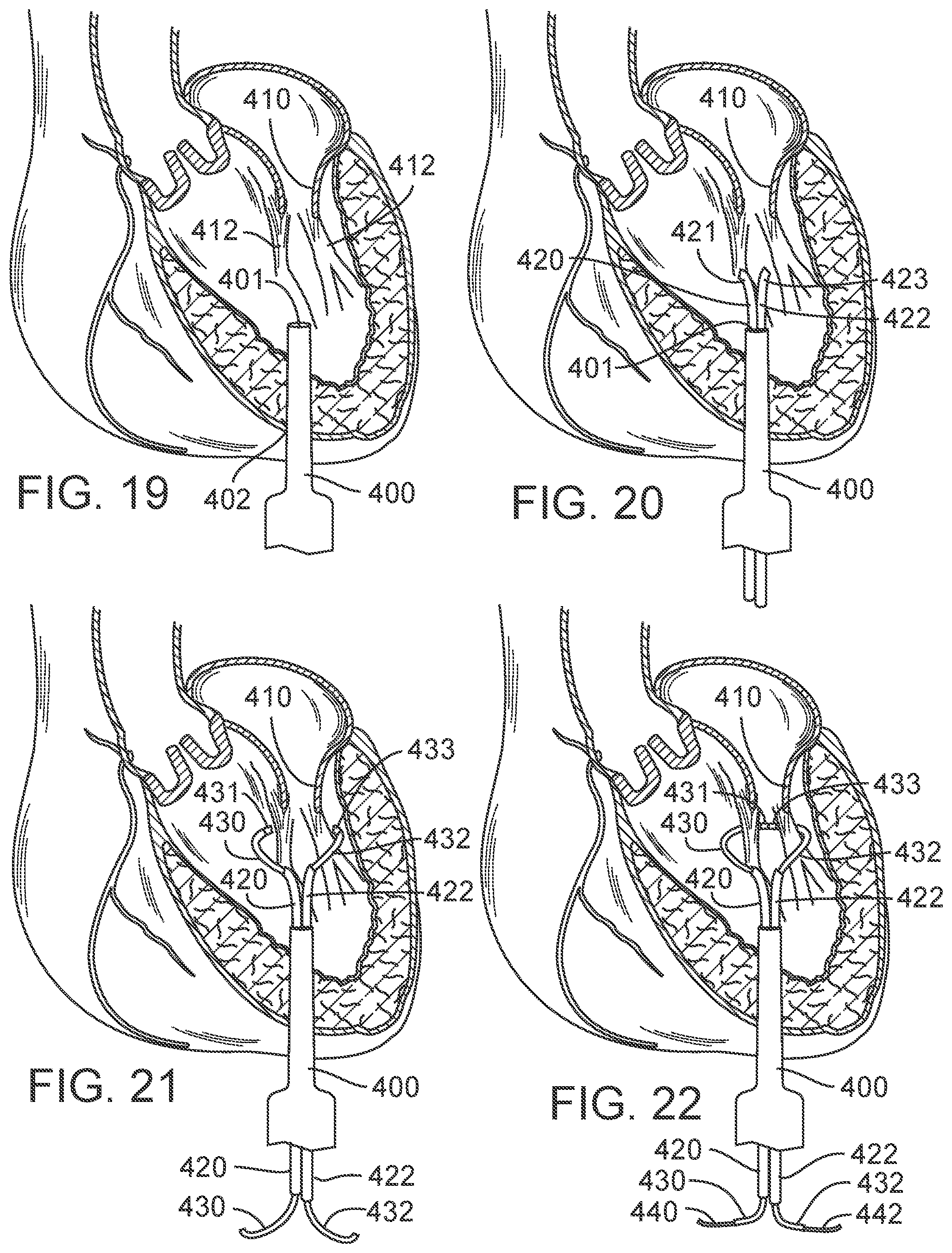 Patent US12090050 Figure 13 – Method for delivering a support member to a native heart valve