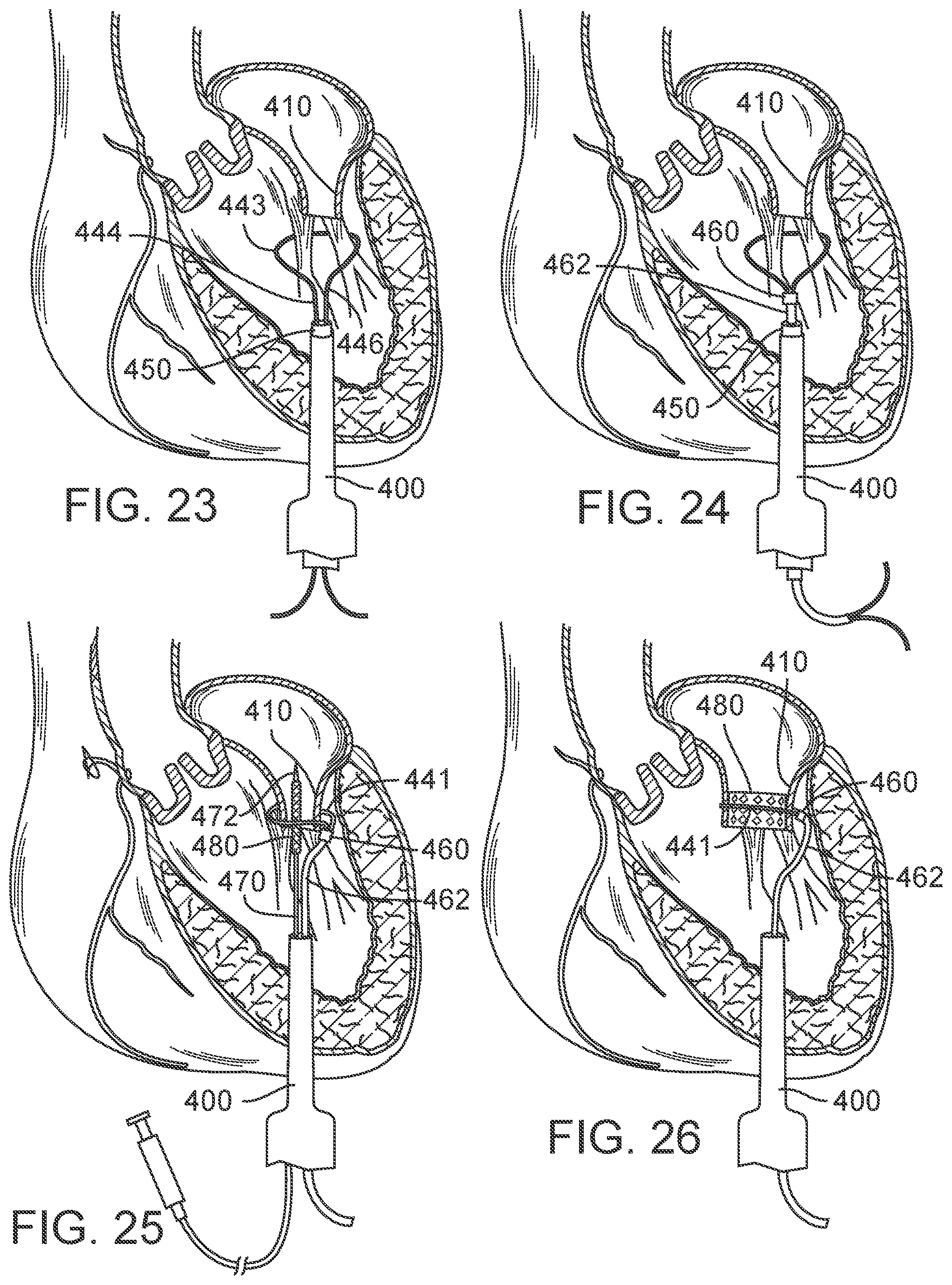 Patent US12090050 Figure 14 – Method for delivering a support member to a native heart valve