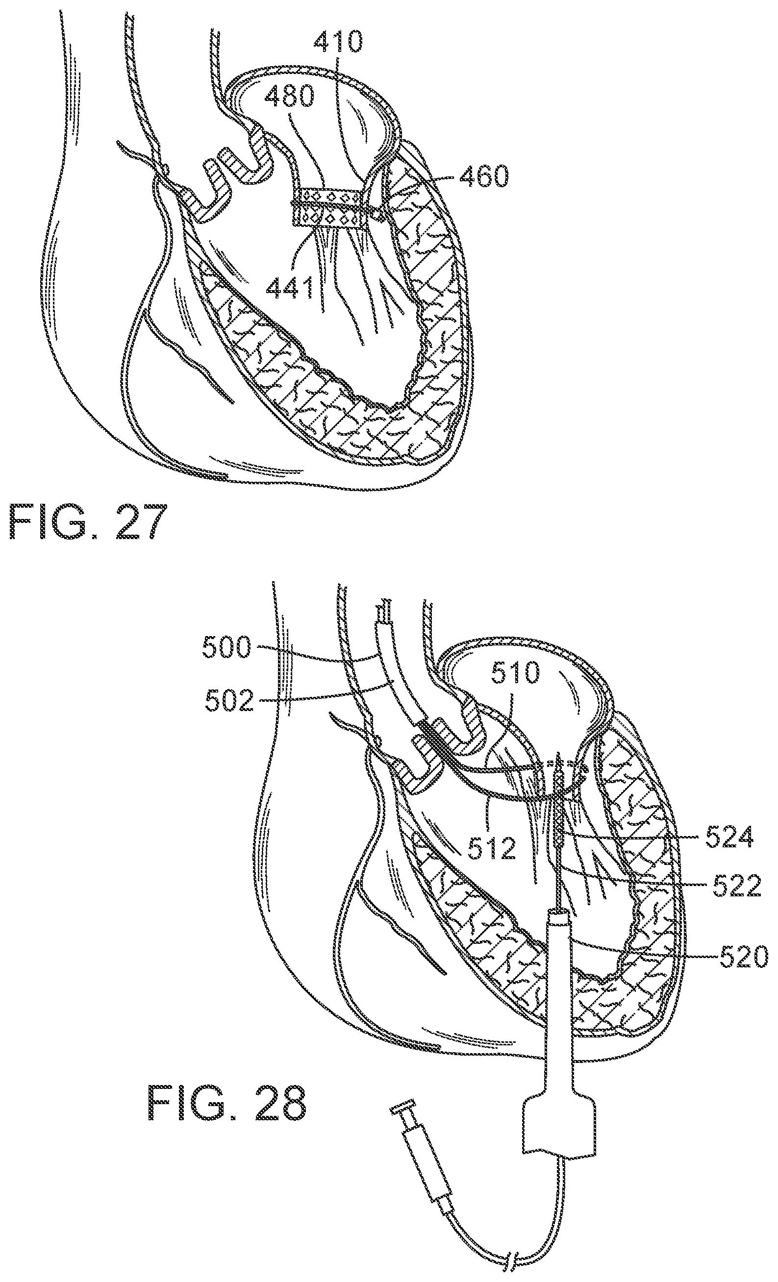 Patent US12090050 Figure 15 – Method for delivering a support member to a native heart valve