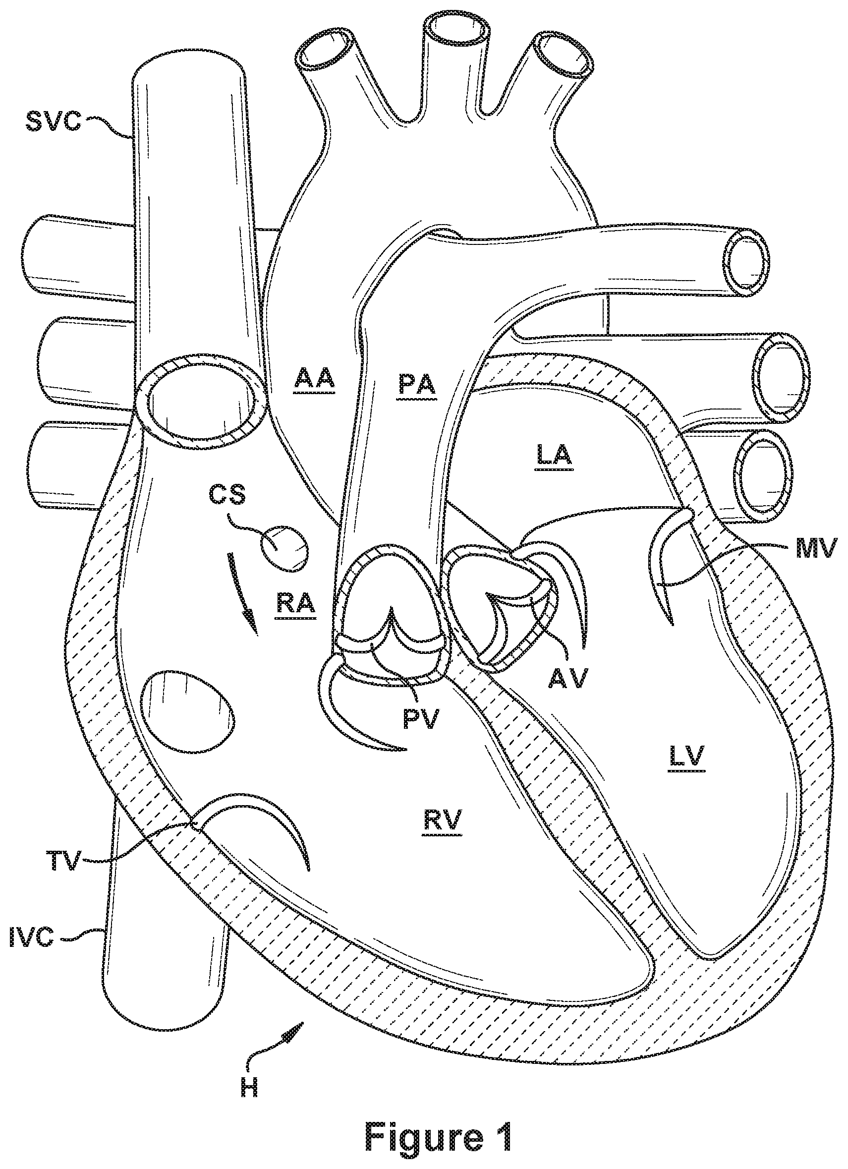 Patent US12090052 Figure 1 – Native valve repair devices and procedures