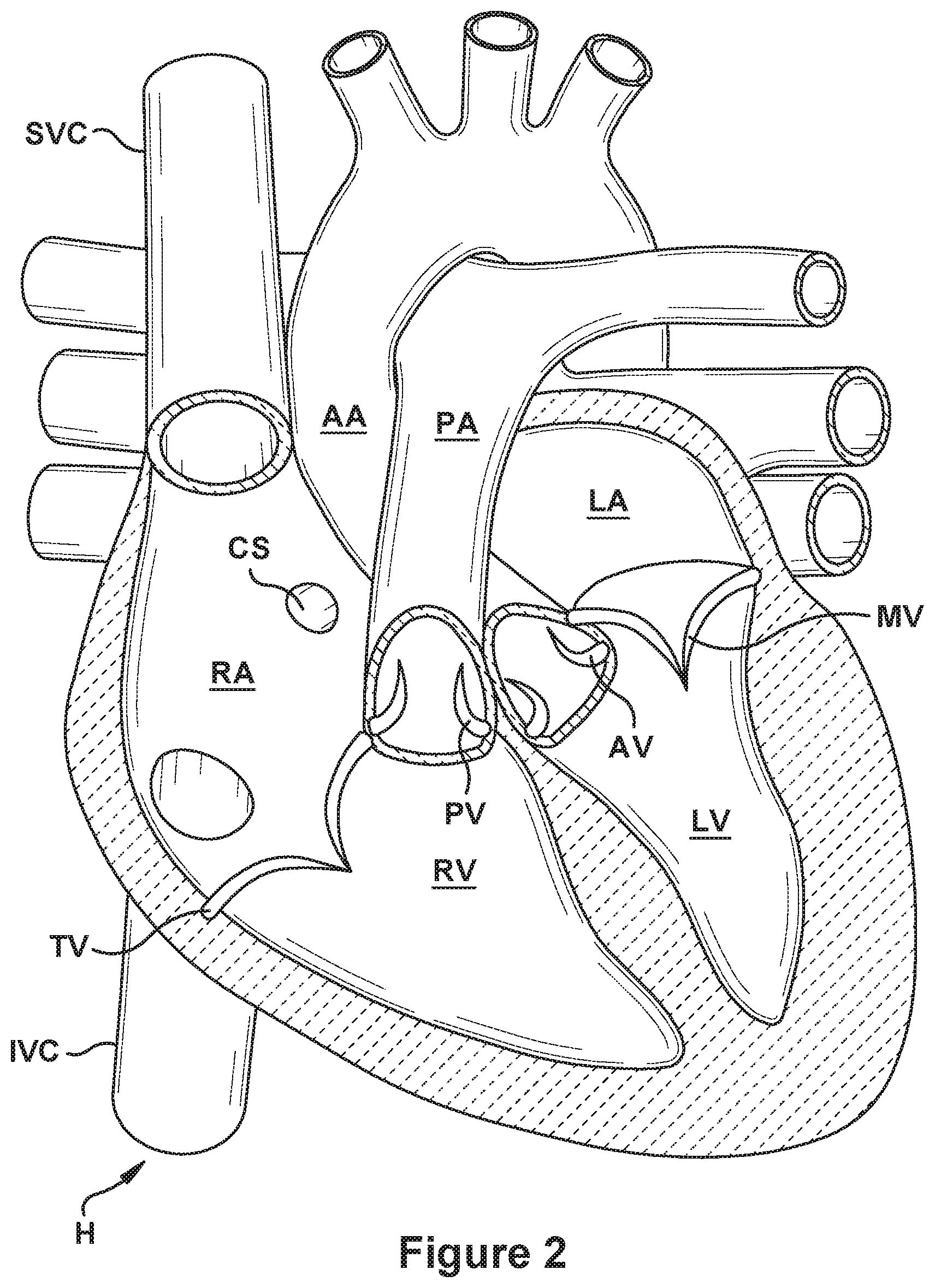 Patent US12090052 Figure 2 – Native valve repair devices and procedures