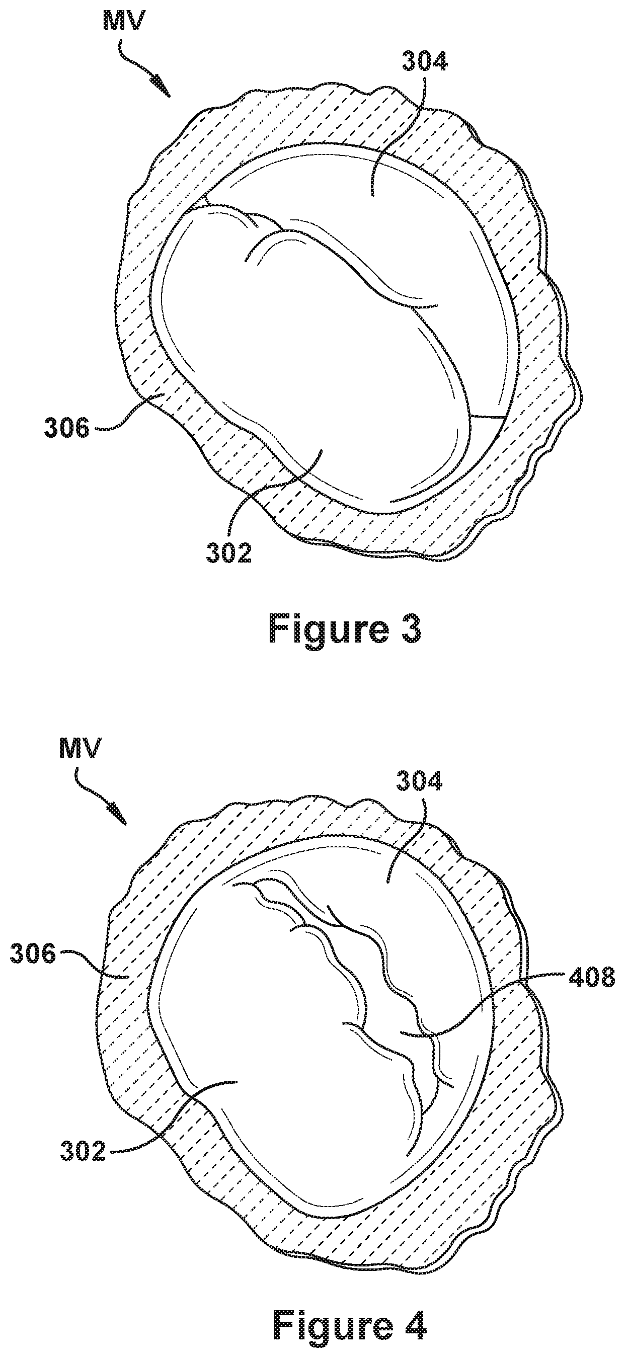 Patent US12090052 Figure 3 – Native valve repair devices and procedures