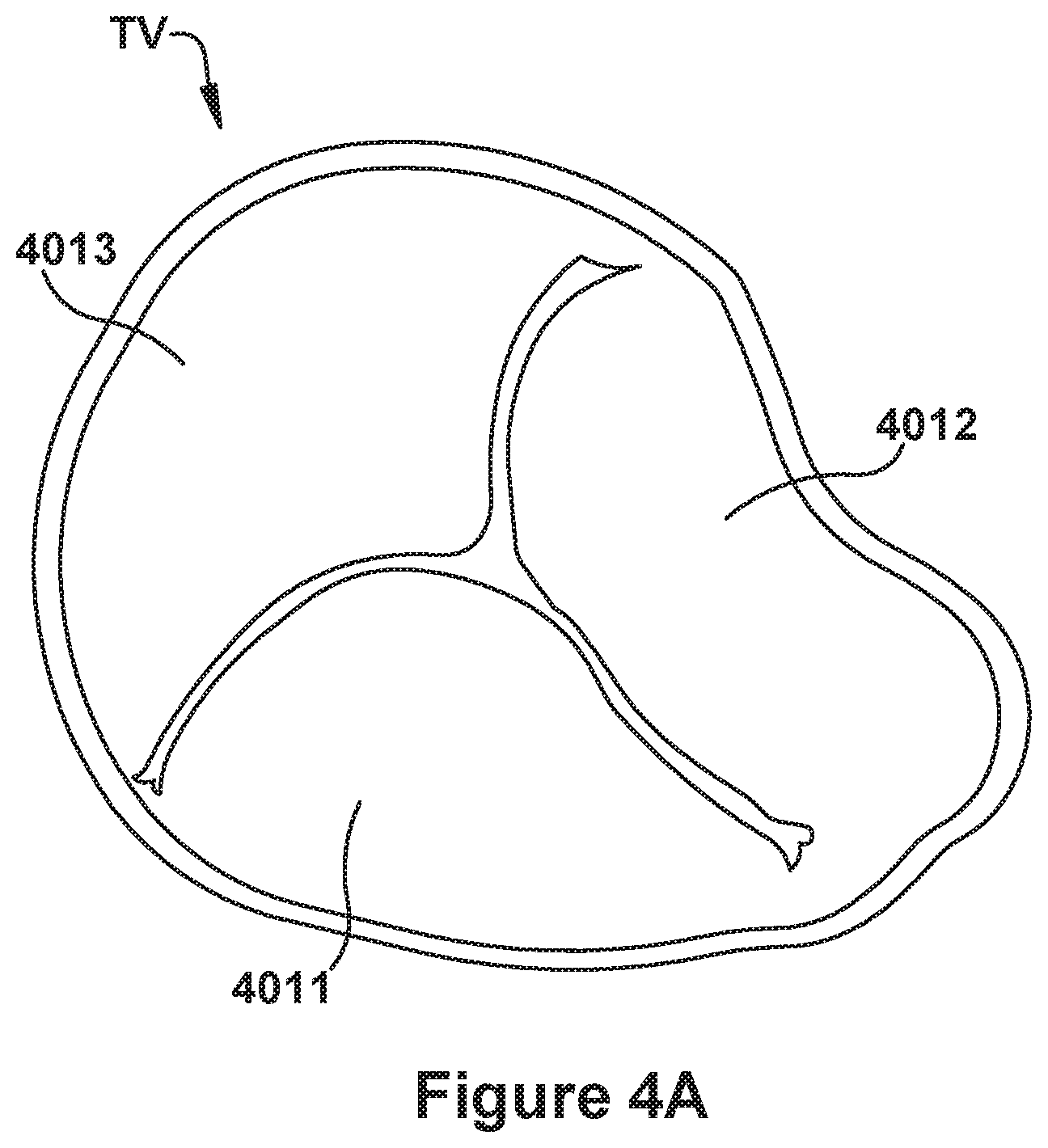 Patent US12090052 Figure 4 – Native valve repair devices and procedures