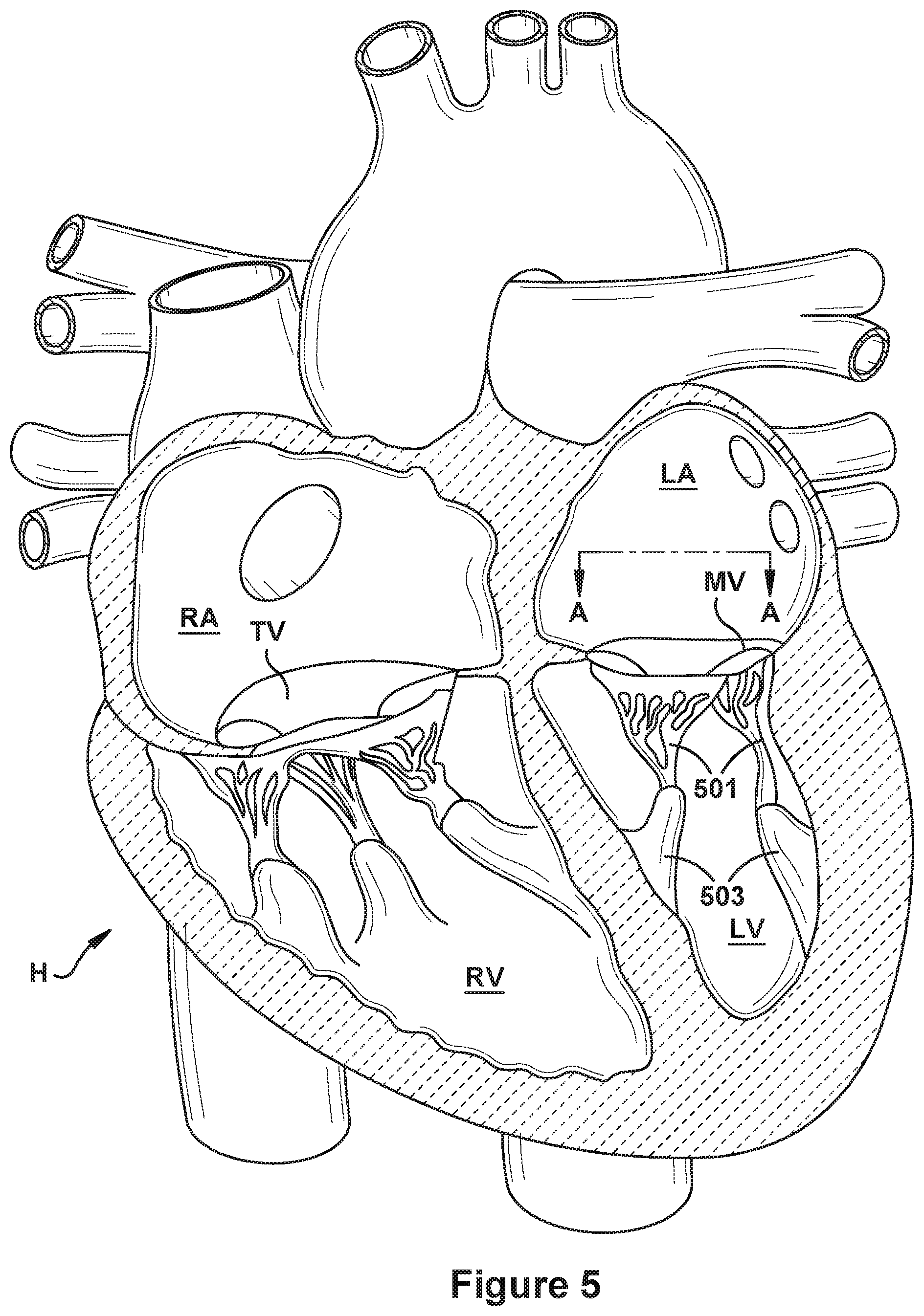 Patent US12090052 Figure 5 – Native valve repair devices and procedures