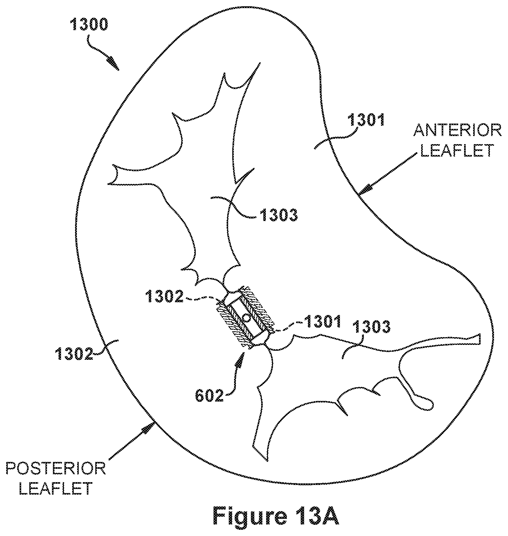 Patent US12090052 Figure 13 – Native valve repair devices and procedures