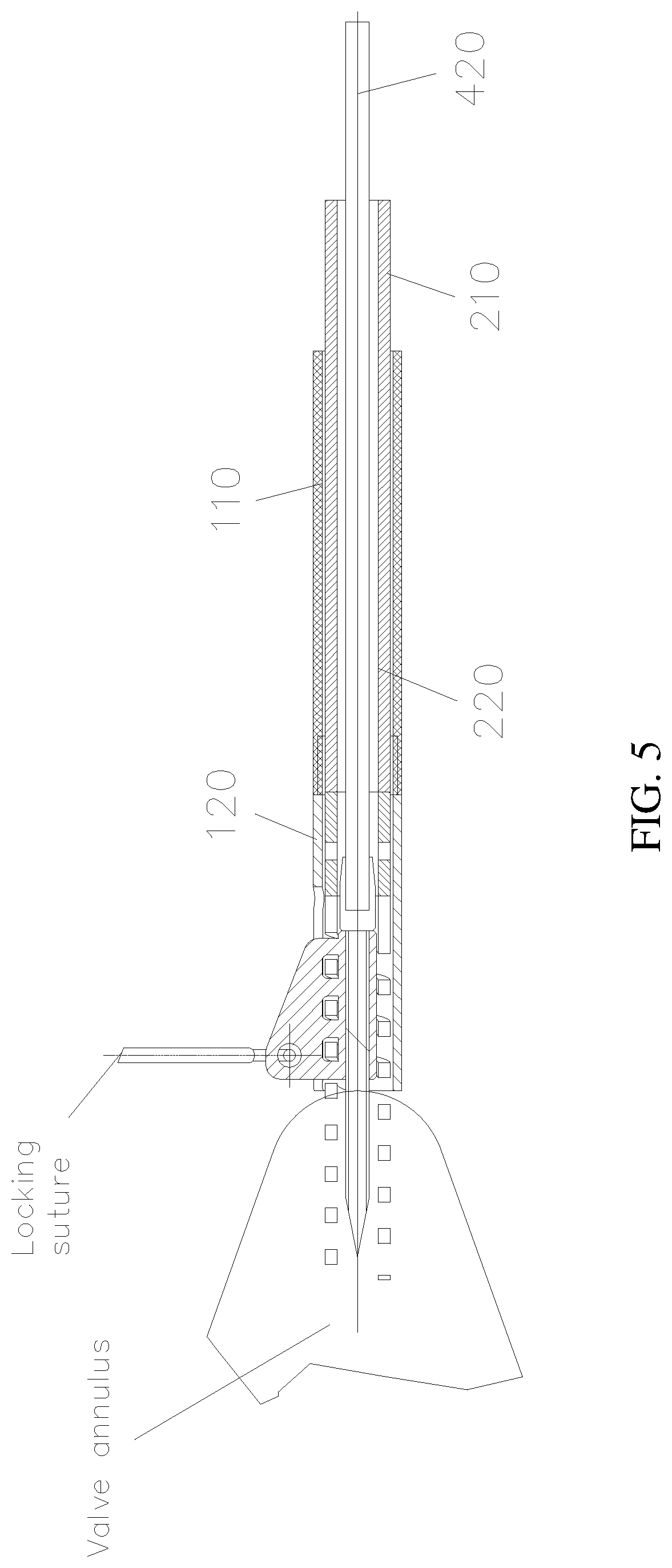 Patent US12090054 Figure 5 – Anchor delivery device for repairing heart valve