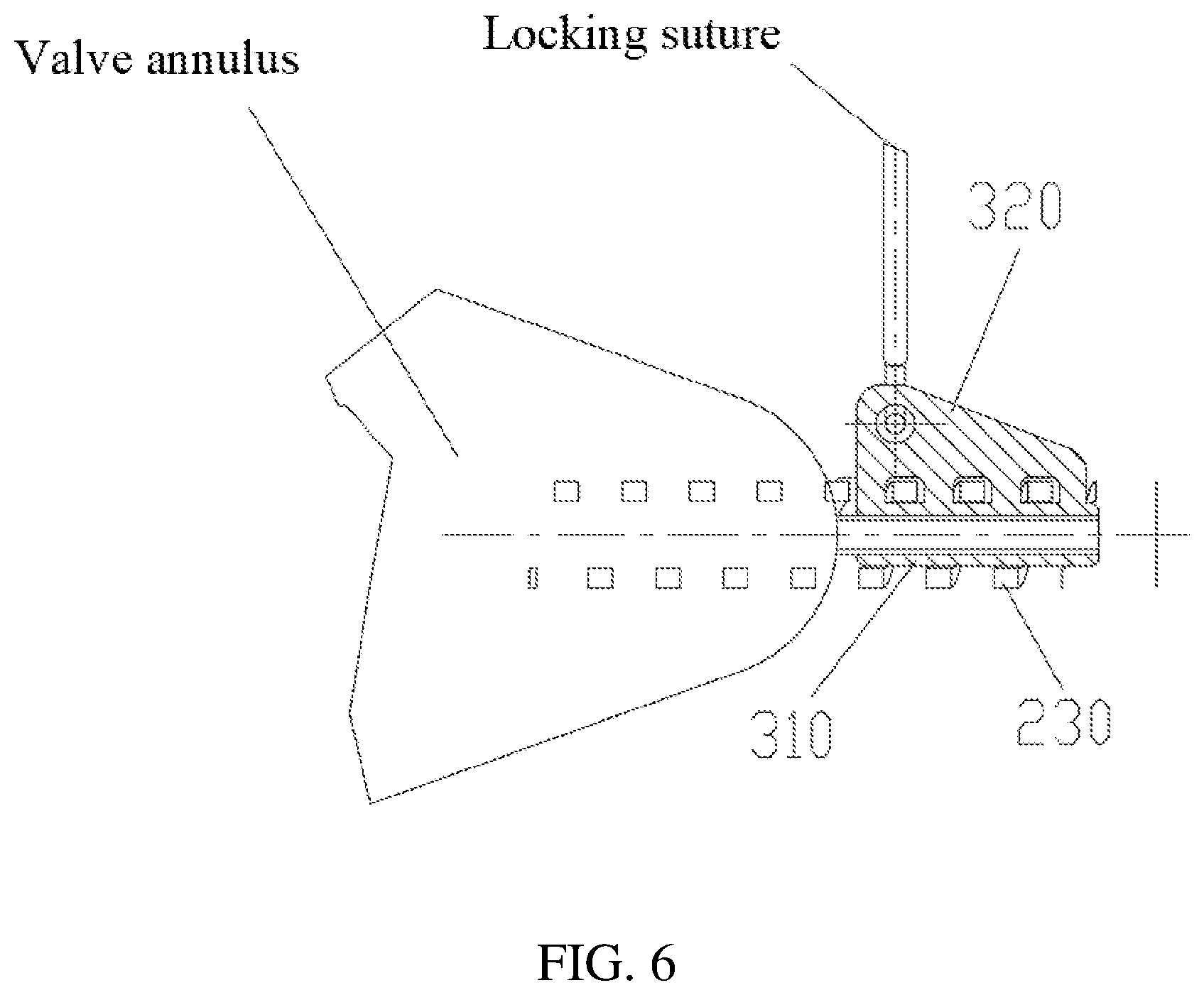 Patent US12090054 Figure 6 – Anchor delivery device for repairing heart valve