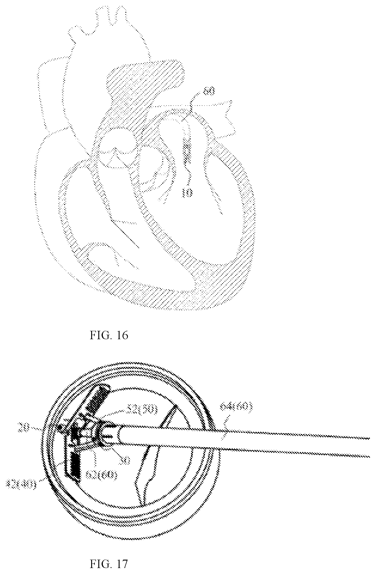 Patent US12090055 Figure 12 – Clamping instrument
