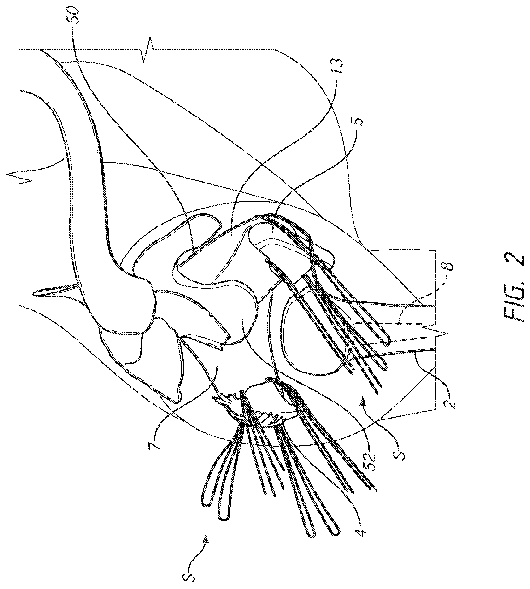 Patent US12090057 Figure 2 – Patient-specific bone fracture prostheses and methods of making the same