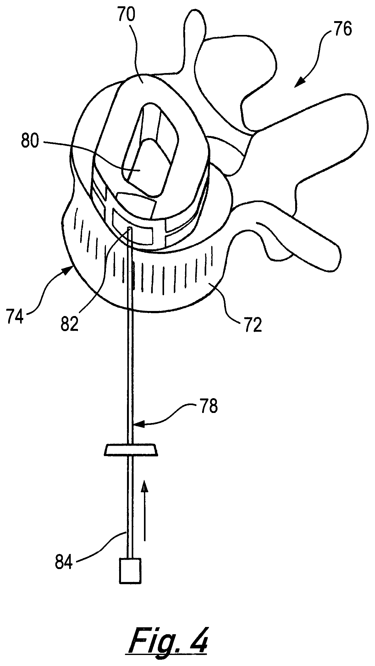 Patent US12090063 Figure 4 – Intervertebral implants