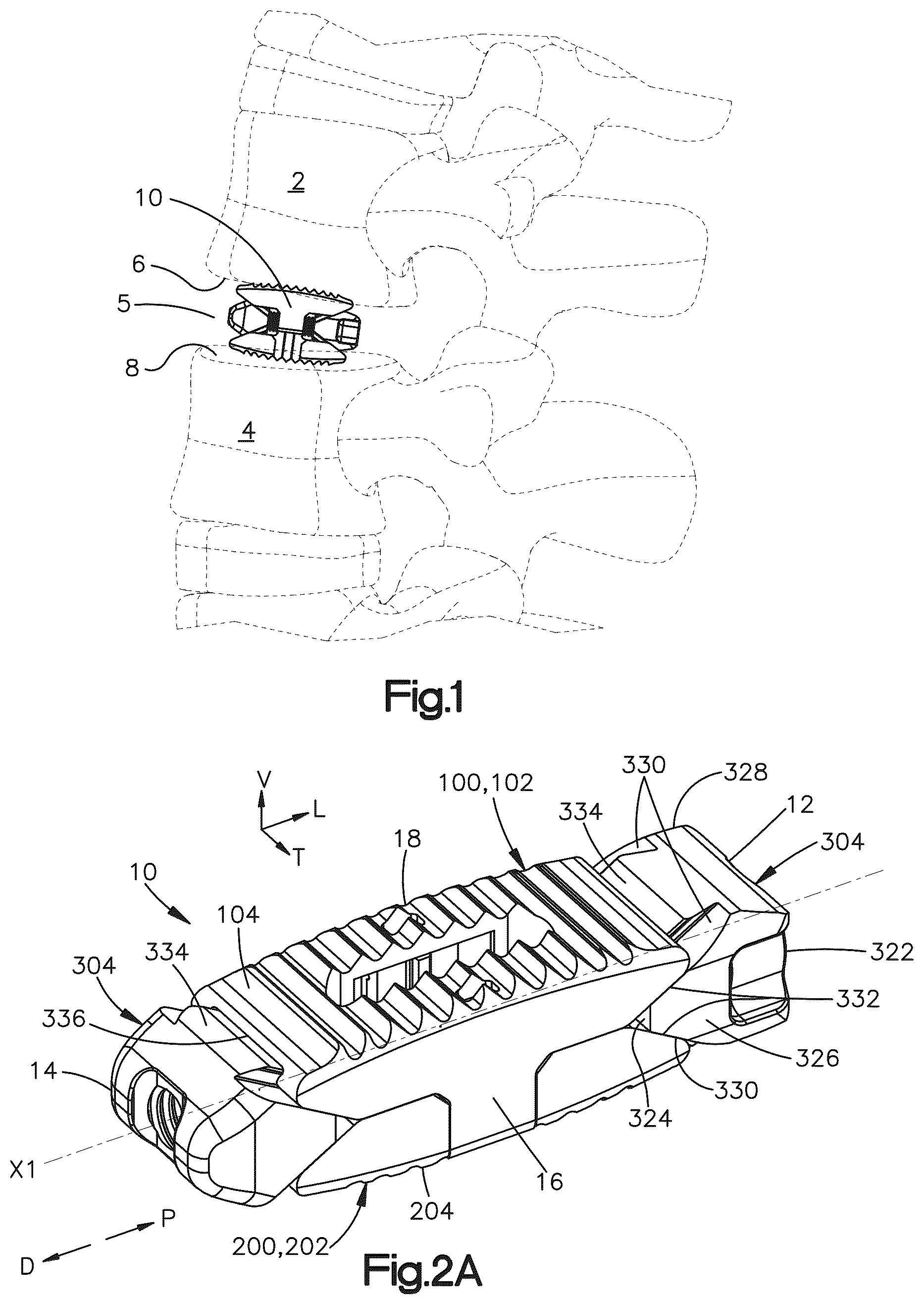 Patent US12090064 Figure 1 – Stabilization members for expandable intervertebral implants, and related systems and methods