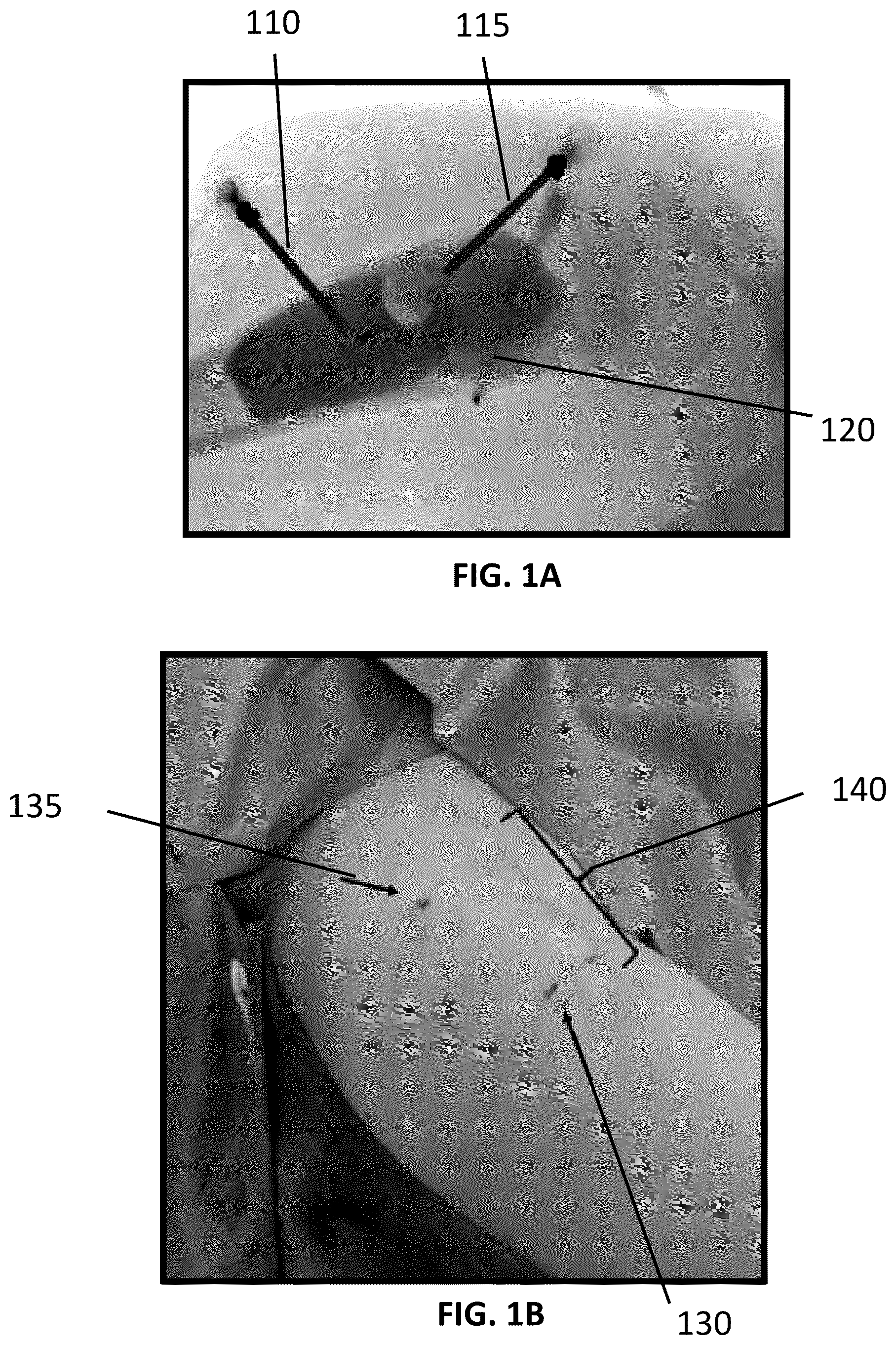 Patent US12090065 Figure 1 – System and method for treatment of bone