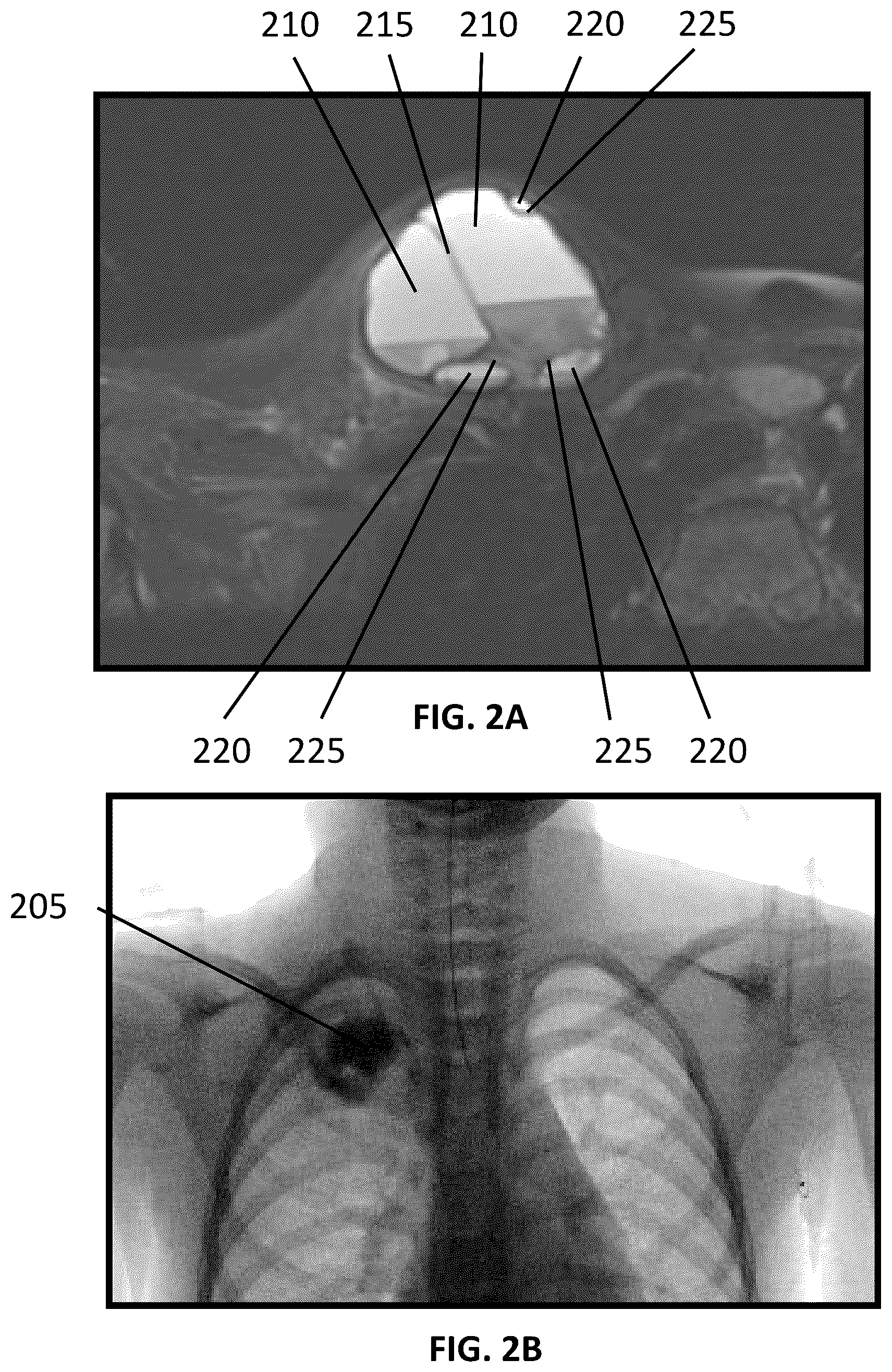 Patent US12090065 Figure 2 – System and method for treatment of bone