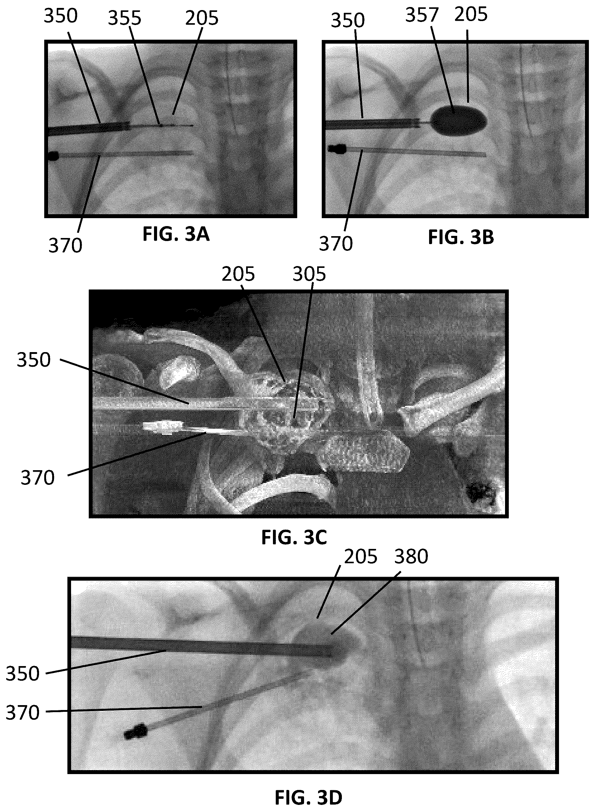 Patent US12090065 Figure 3 – System and method for treatment of bone