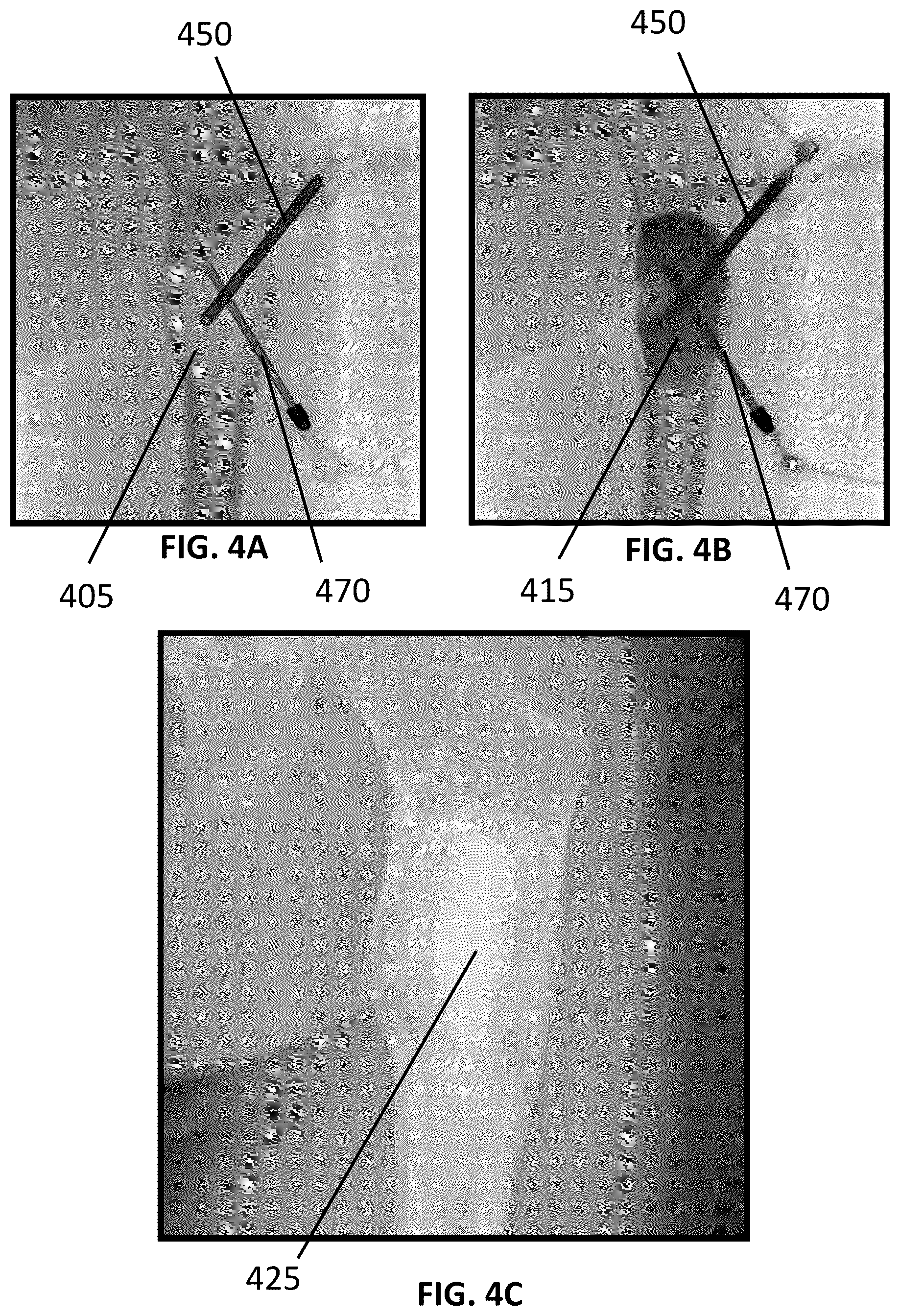 Patent US12090065 Figure 4 – System and method for treatment of bone