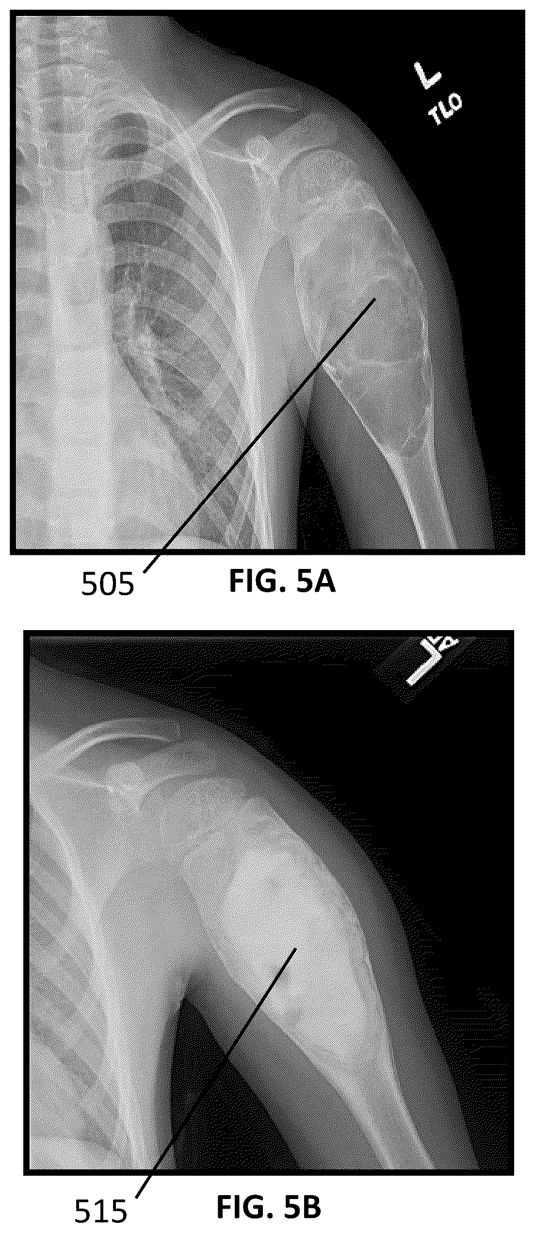 Patent US12090065 Figure 5 – System and method for treatment of bone