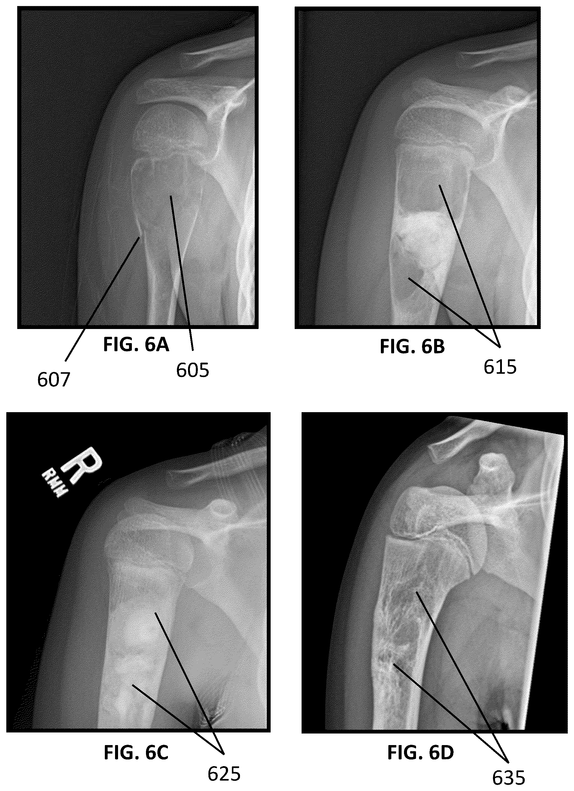 Patent US12090065 Figure 6 – System and method for treatment of bone