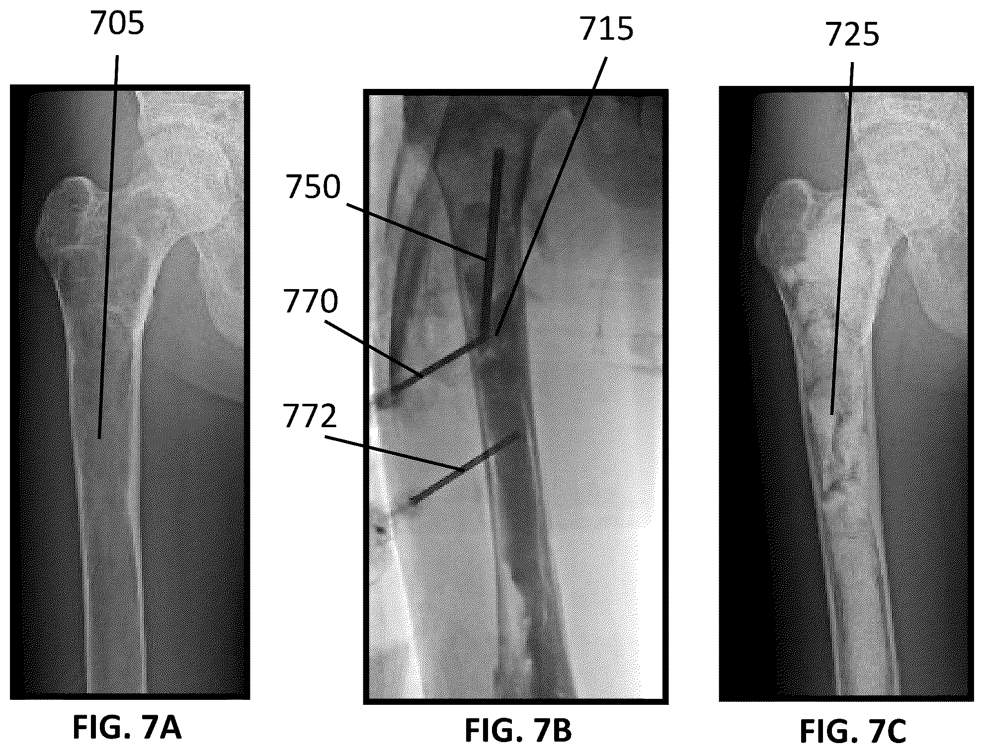 Patent US12090065 Figure 7 – System and method for treatment of bone