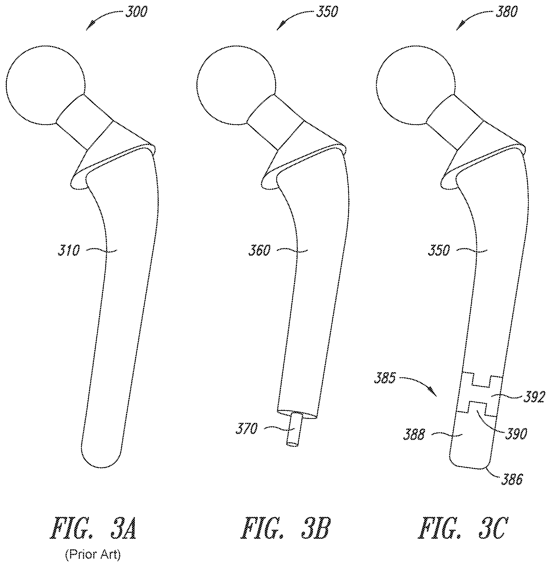 Patent US12090066 Figure 3 – Multi-piece implantable joint prosthesis