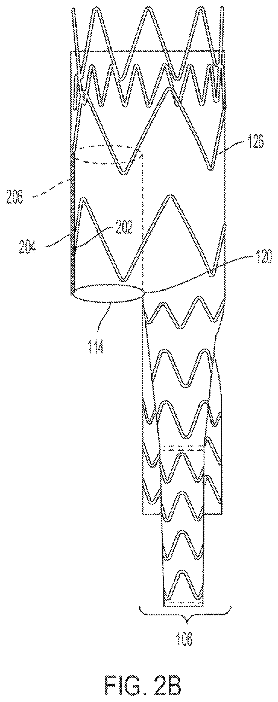 Patent US12090070 Figure 4 – Re-location of main body bypass branch on multi-branched stent graft