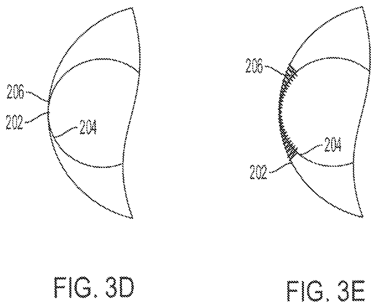 Patent US12090070 Figure 7 – Re-location of main body bypass branch on multi-branched stent graft