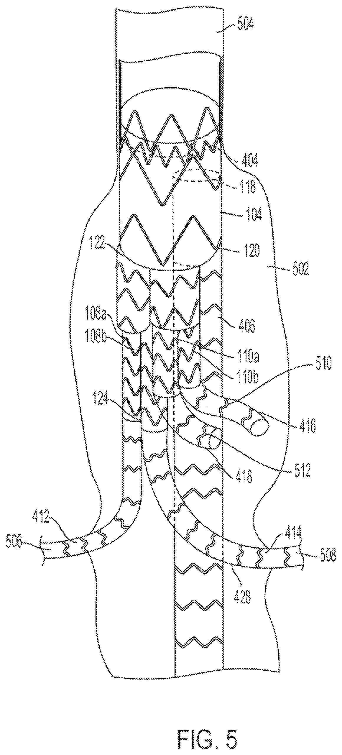 Patent US12090070 Figure 9 – Re-location of main body bypass branch on multi-branched stent graft