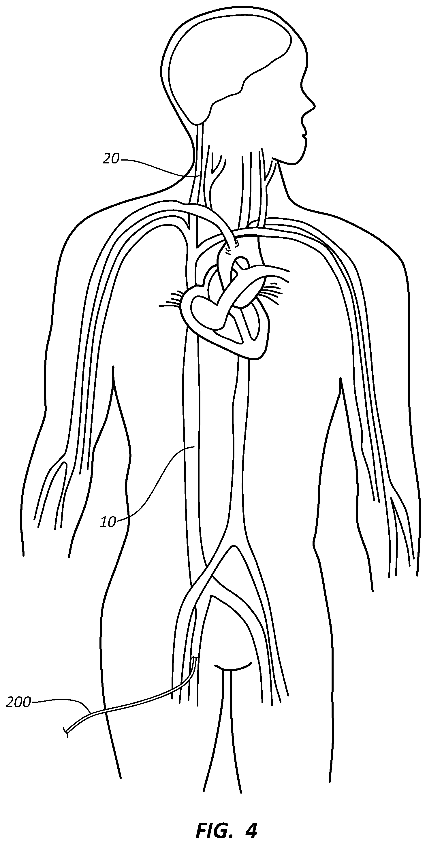 Patent US12090072 Figure 3 – Systems and methods for delivery retrievable stents