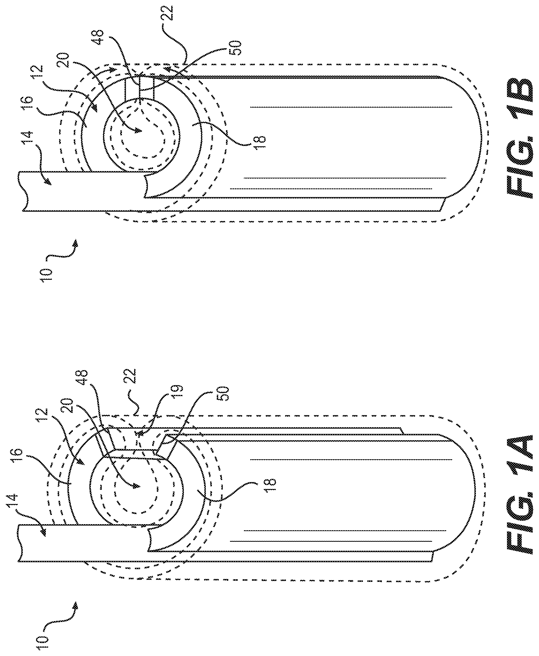 Patent US12090076 Figure 1 – Devices and related methods for gastrectomies