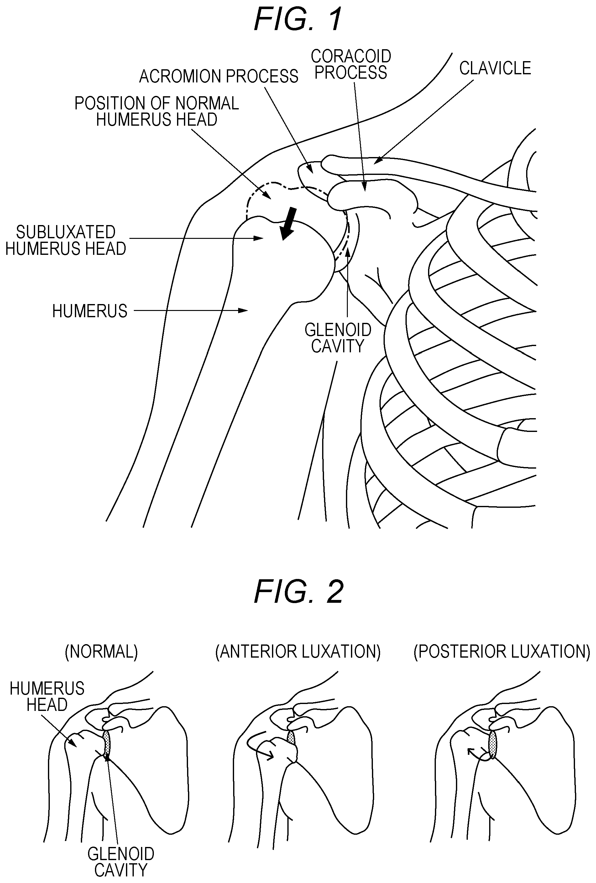 Patent US12090081 Figure 1 – Shoulder brace and rehabilitation method using shoulder brace