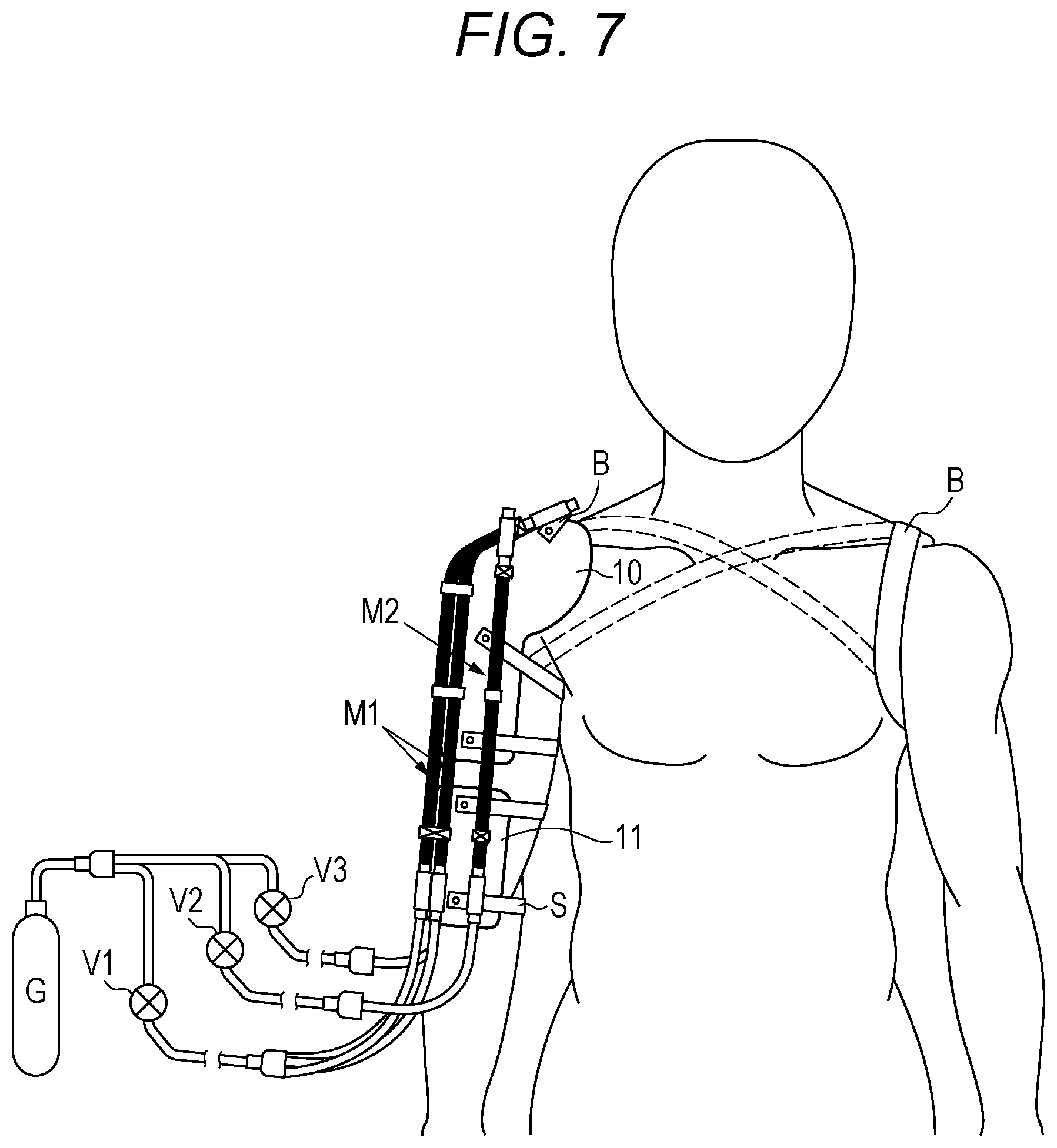 Patent US12090081 Figure 5 – Shoulder brace and rehabilitation method using shoulder brace