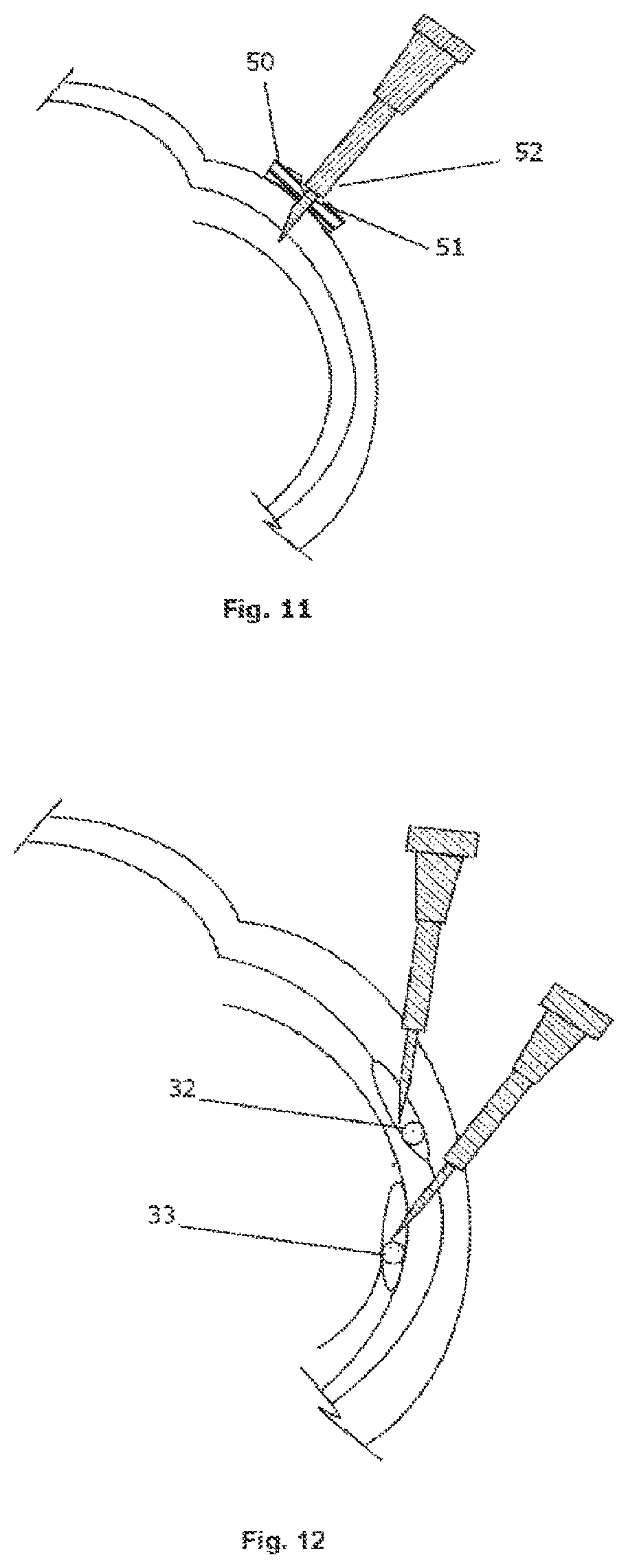 Patent US12090088 Figure 5 – Device for ocular access