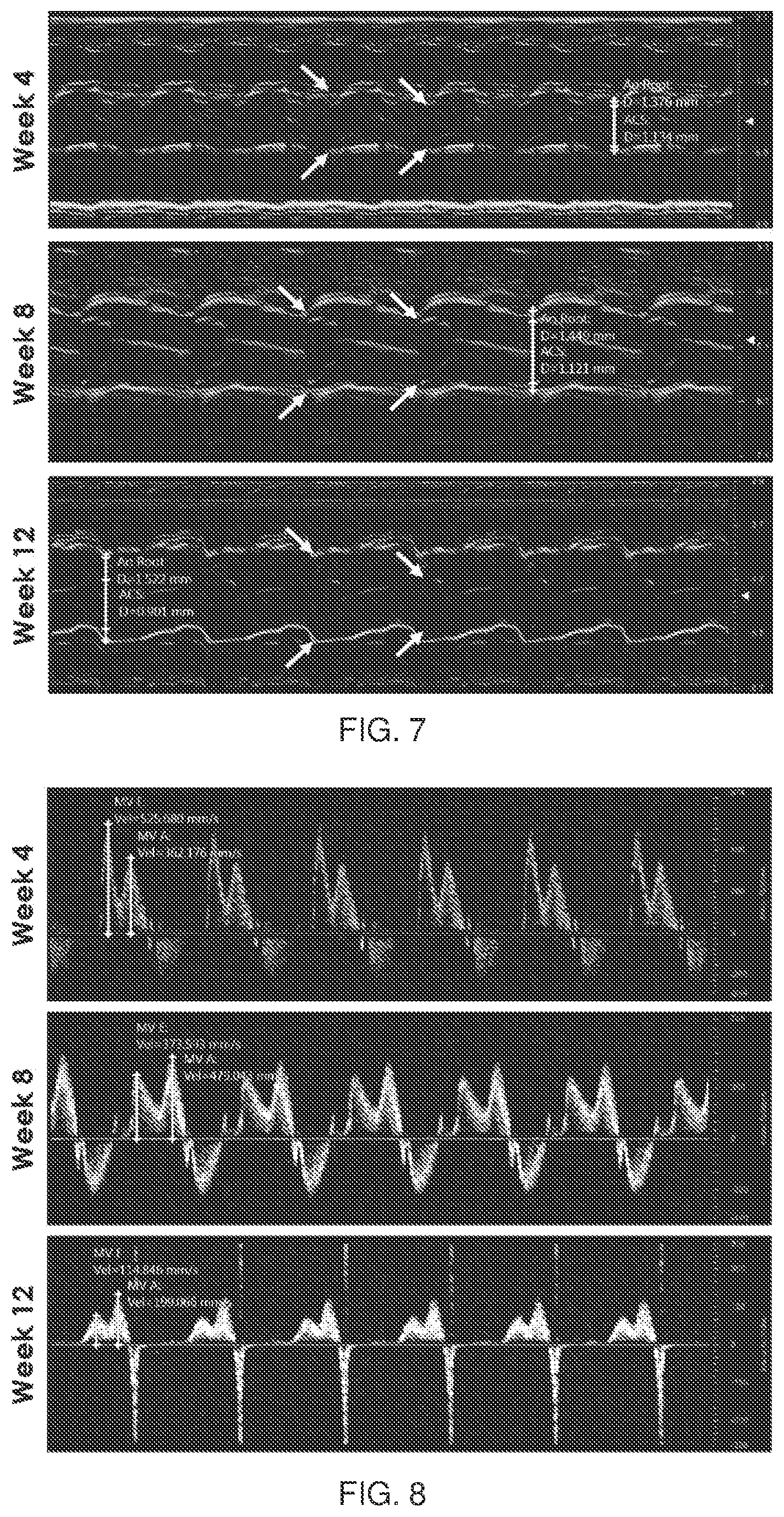 Patent US12090127 Figure 7 – Methods for treating pulmonary fibrosis with a hedgehog pathway inhibitor