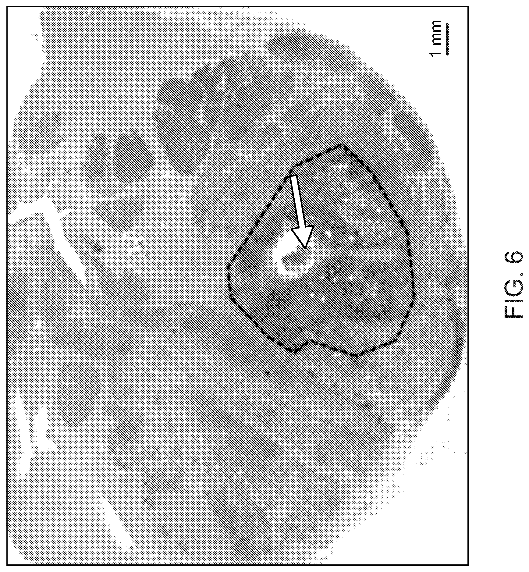Patent US12090136 Figure 8 – Apparatus for treating Benign Prostatic Hyperplasia