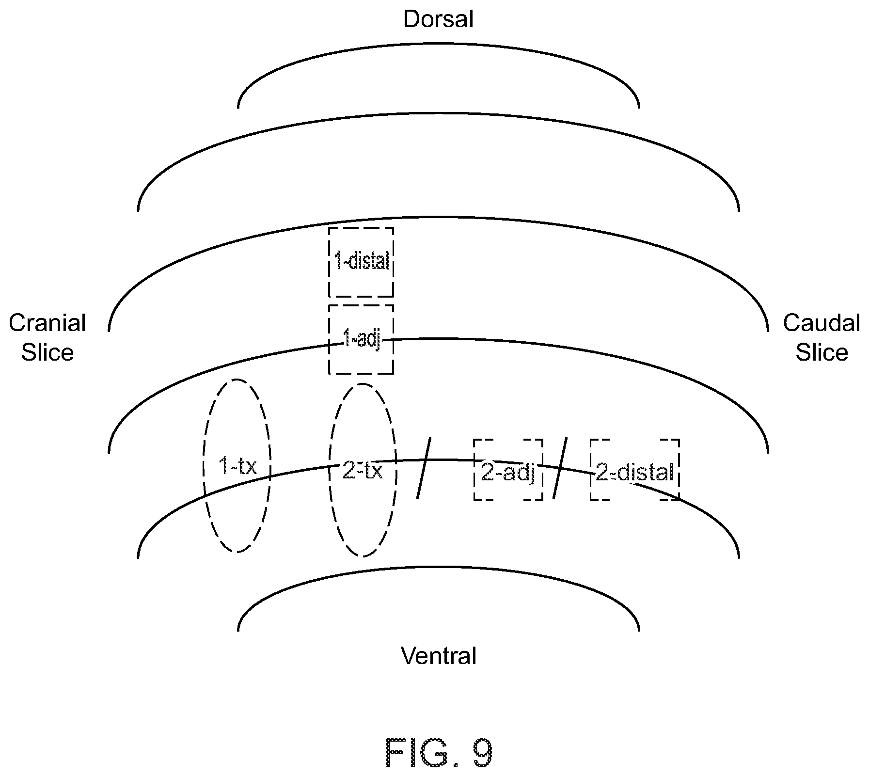 Patent US12090136 Figure 11 – Apparatus for treating Benign Prostatic Hyperplasia