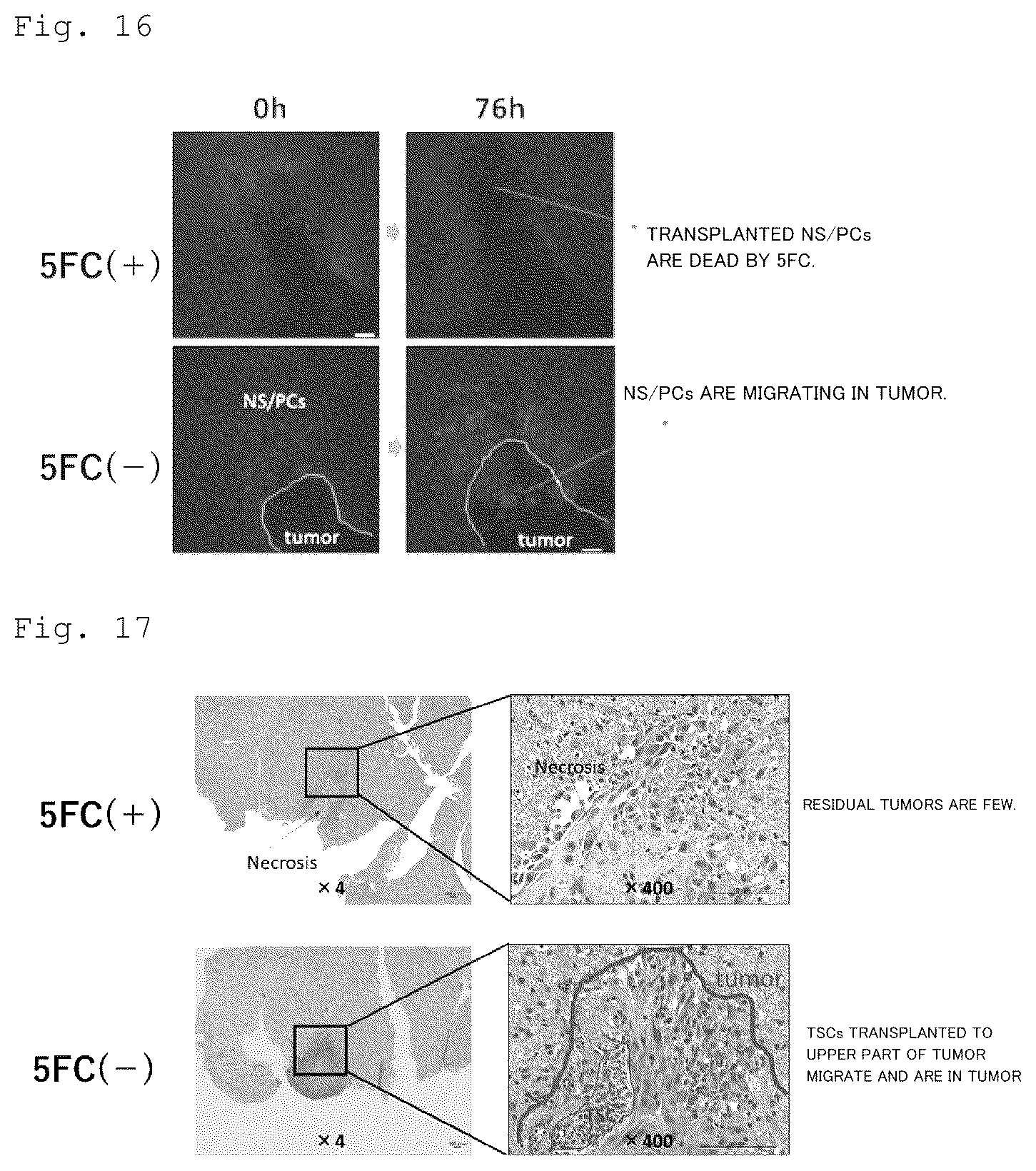 Patent US12090172 Figure 9 – Suicide gene therapeutic agent for brain tumors using pluripotent stem cell