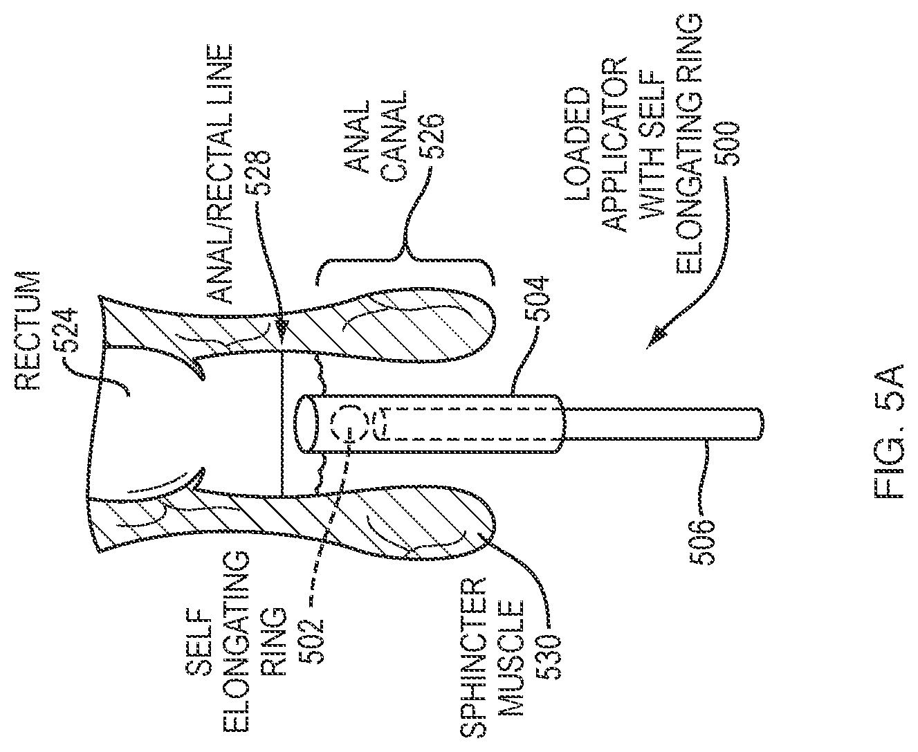 Patent US12090226 Figure 6 – Hydrocortisone acetate suppository formulation for treatment of disease