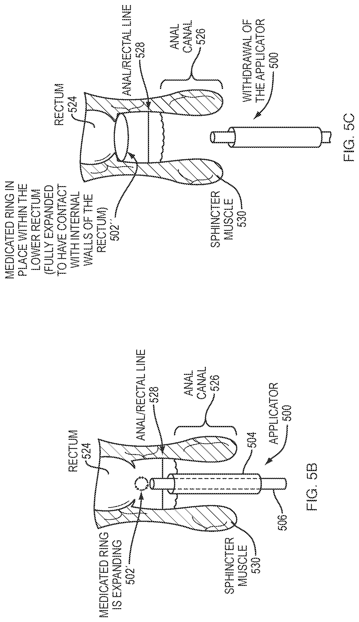 Patent US12090226 Figure 7 – Hydrocortisone acetate suppository formulation for treatment of disease